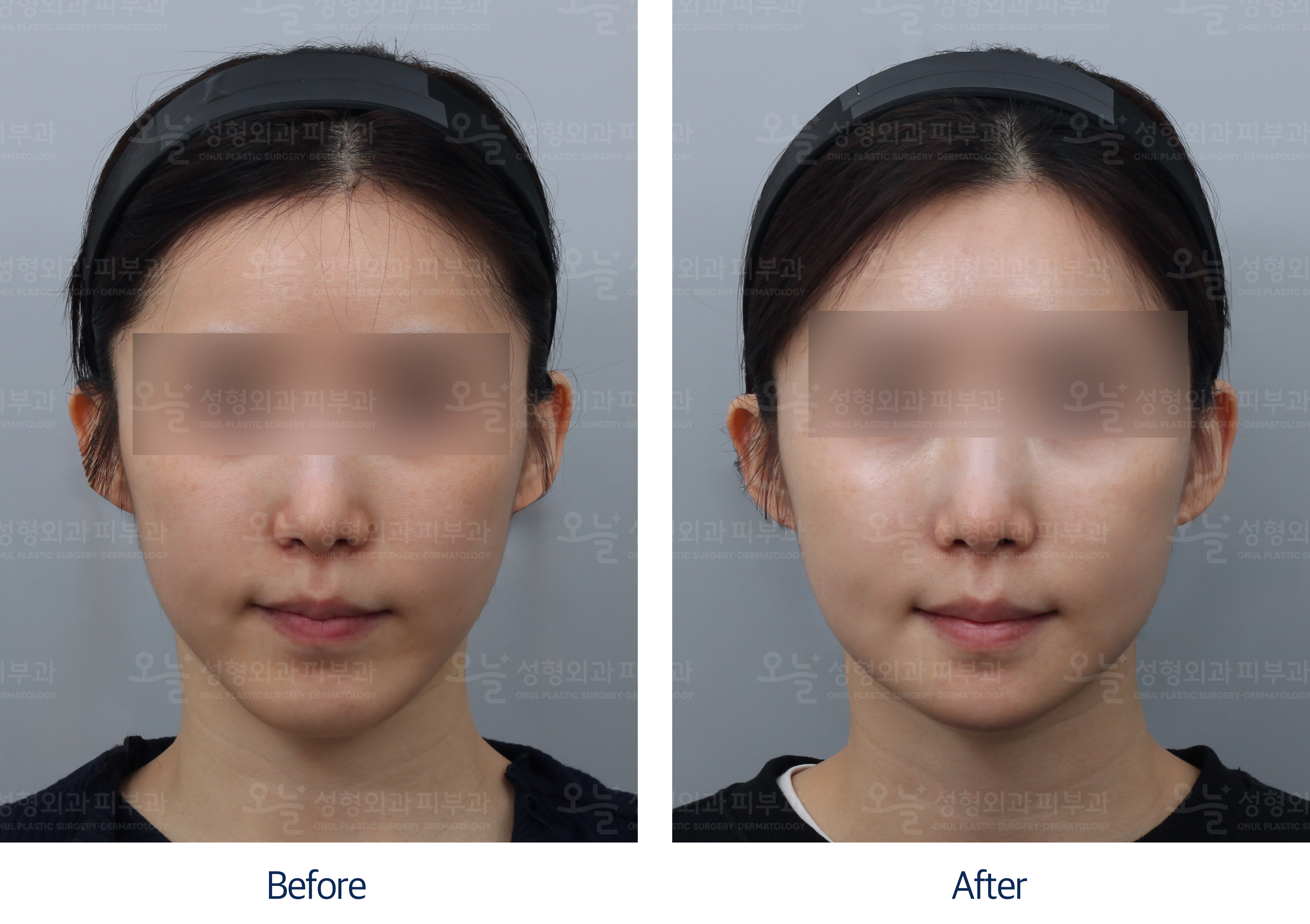 오늘성형외과 전후사진