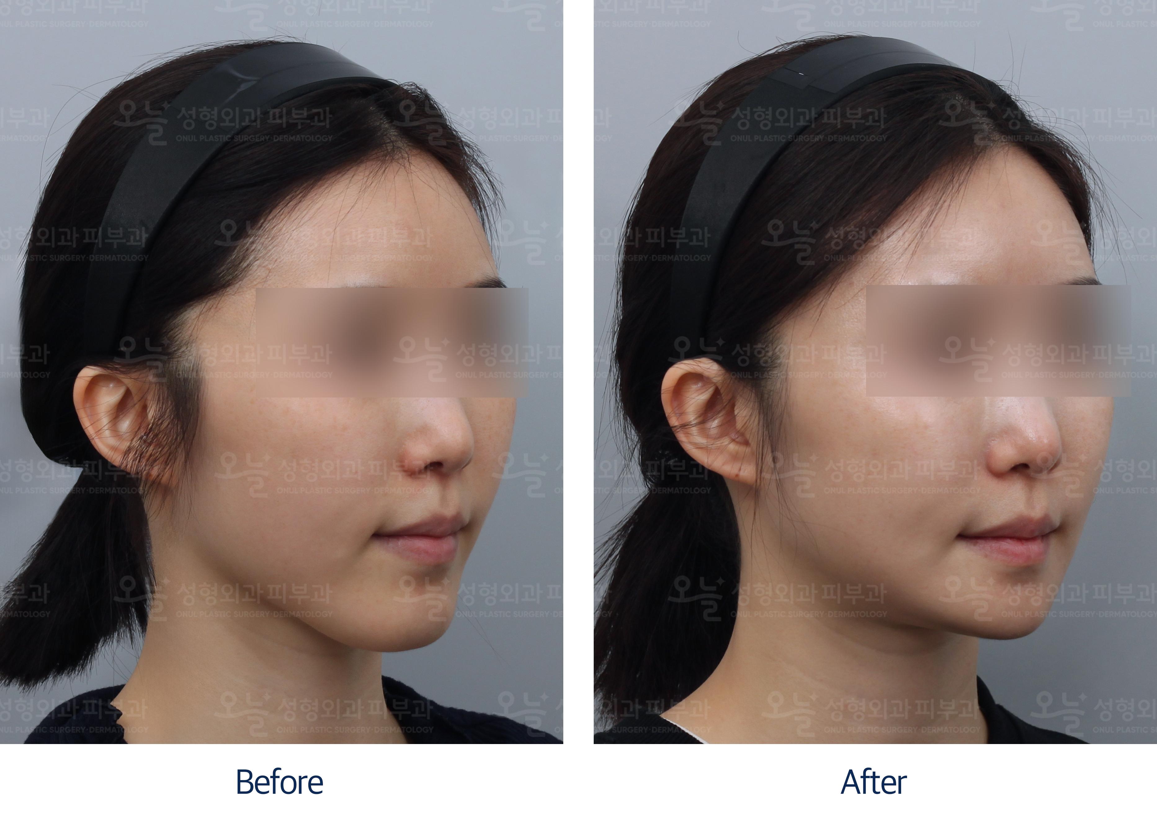 오늘성형외과 전후사진
