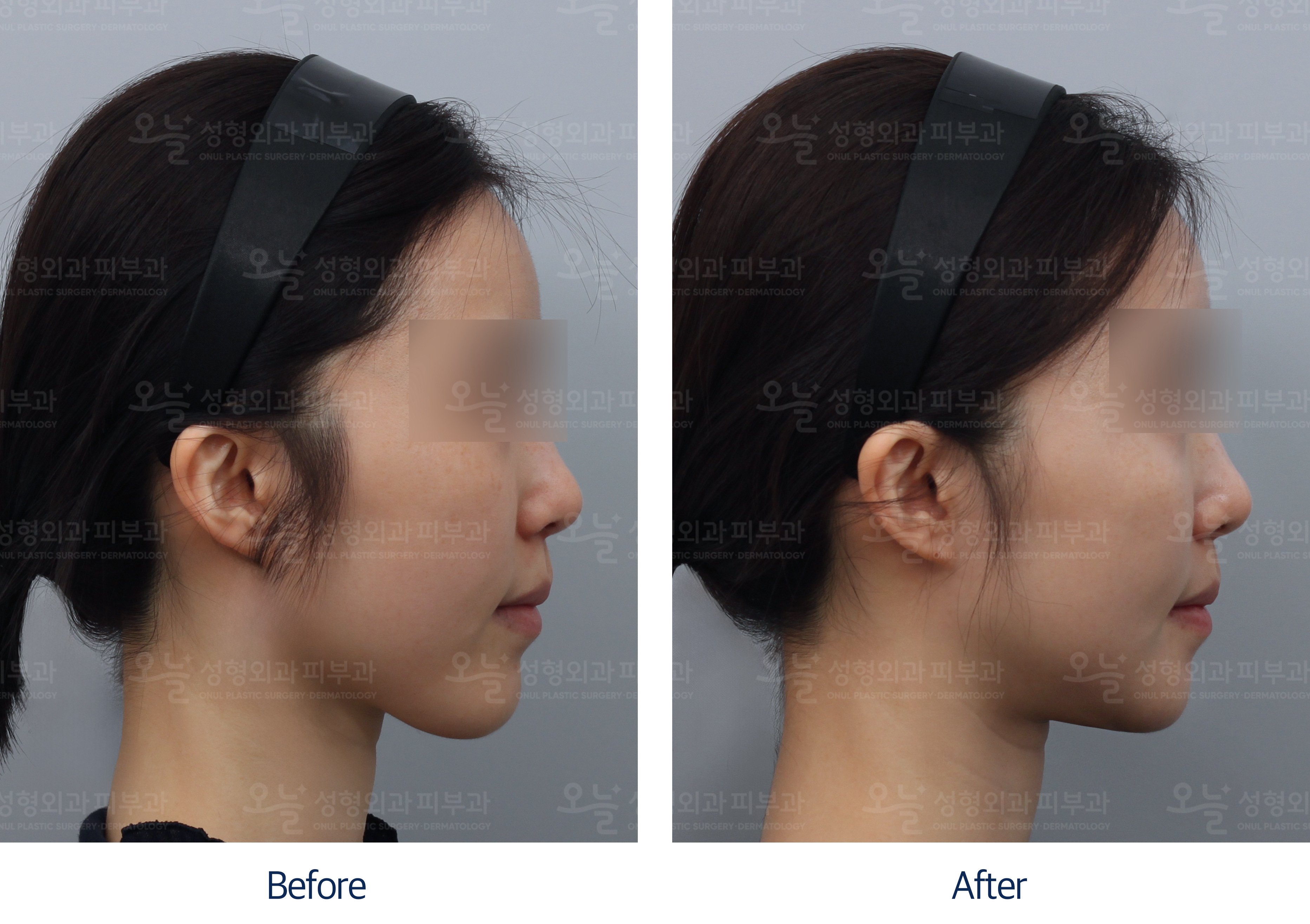 오늘성형외과 전후사진