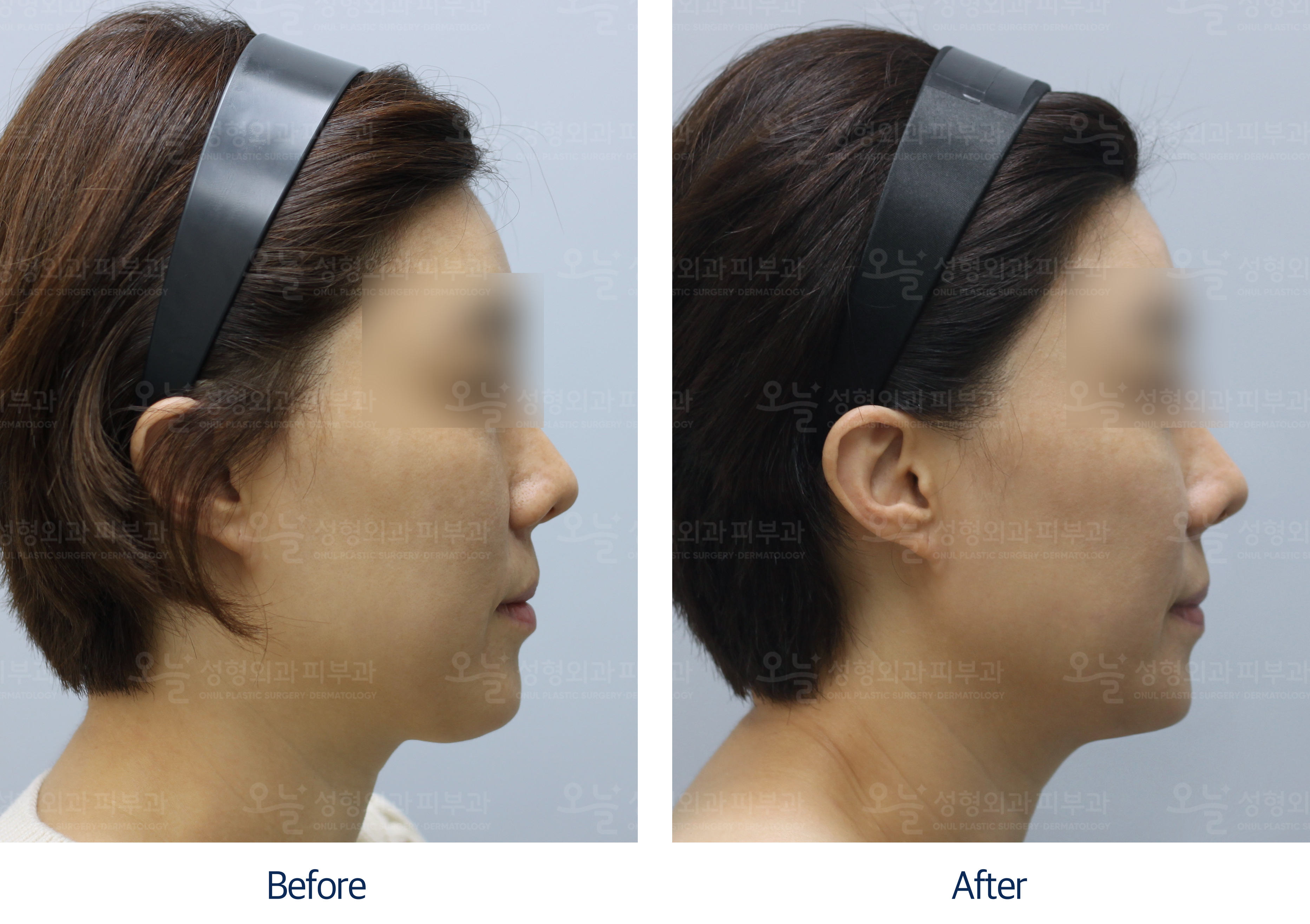 오늘성형외과 전후사진