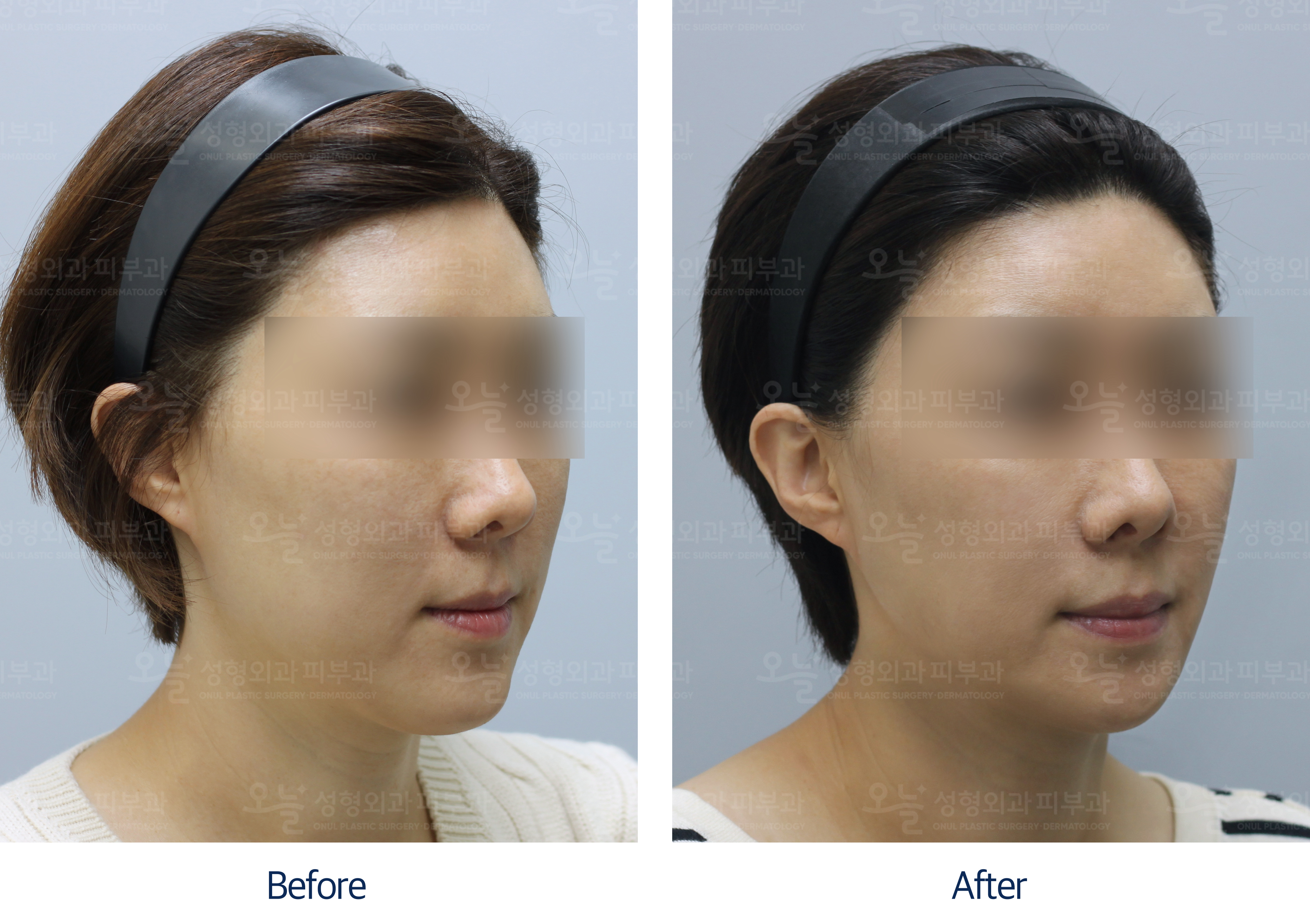 오늘성형외과 전후사진