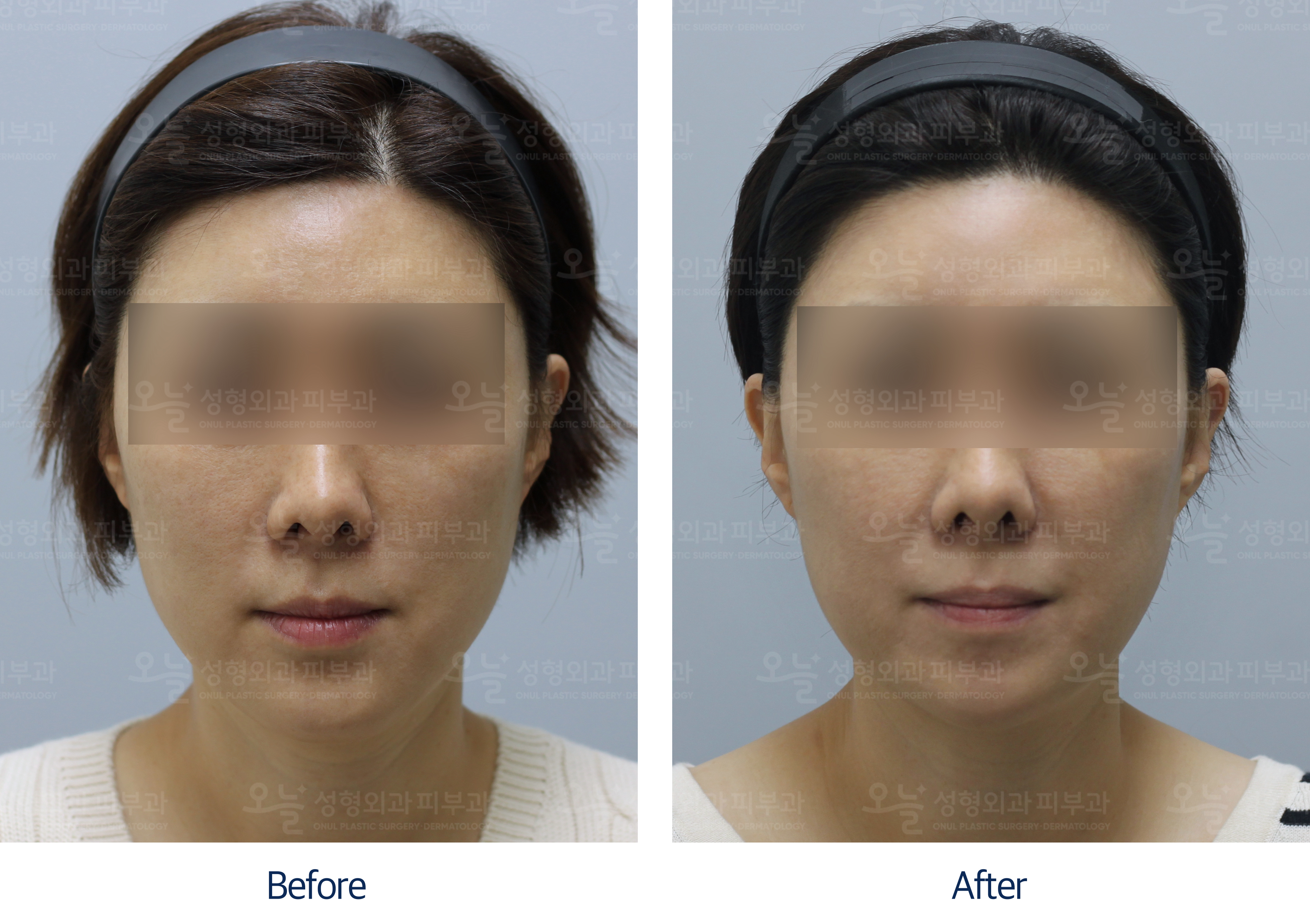 오늘성형외과 전후사진