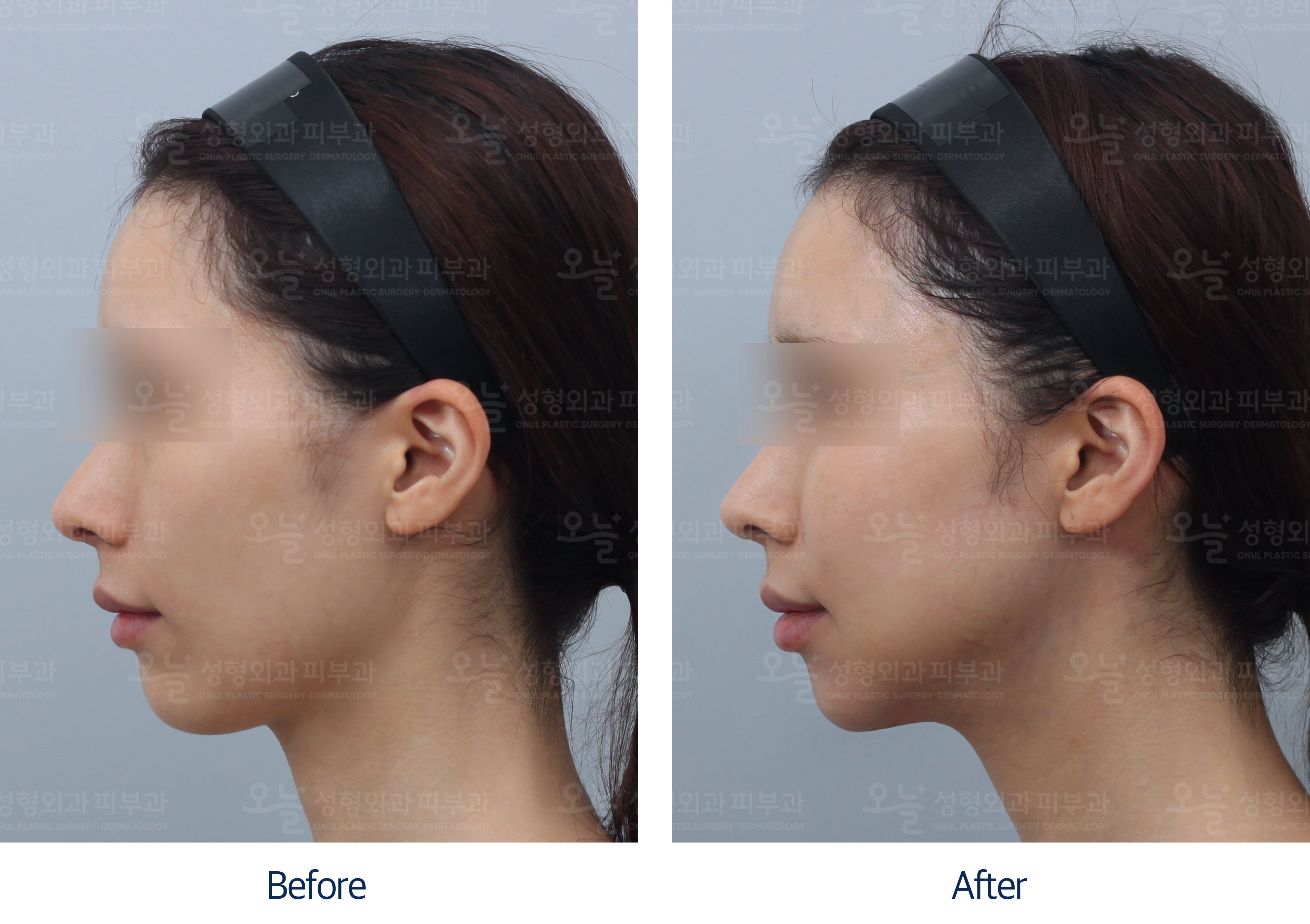 오늘성형외과 전후사진