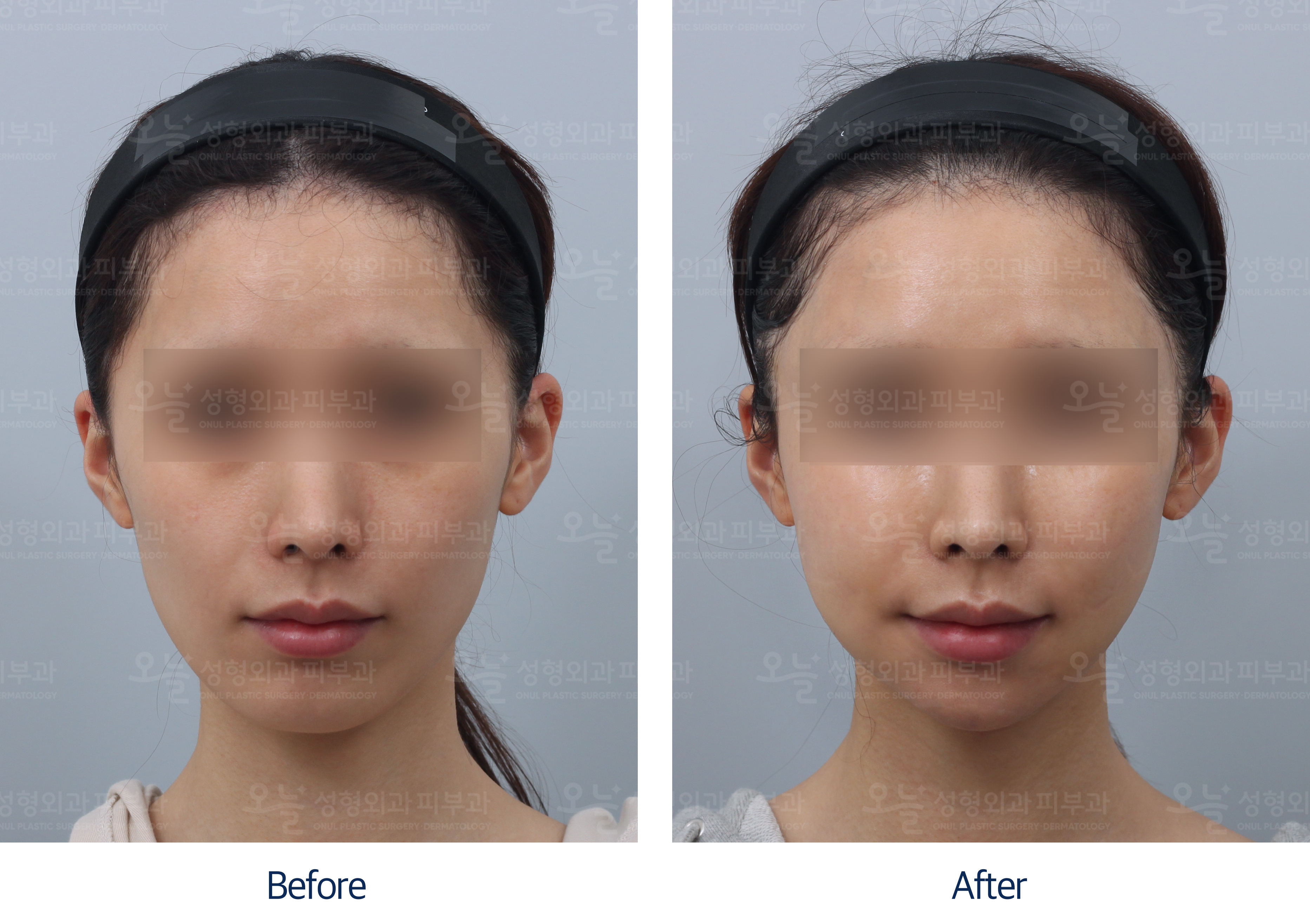 오늘성형외과 전후사진