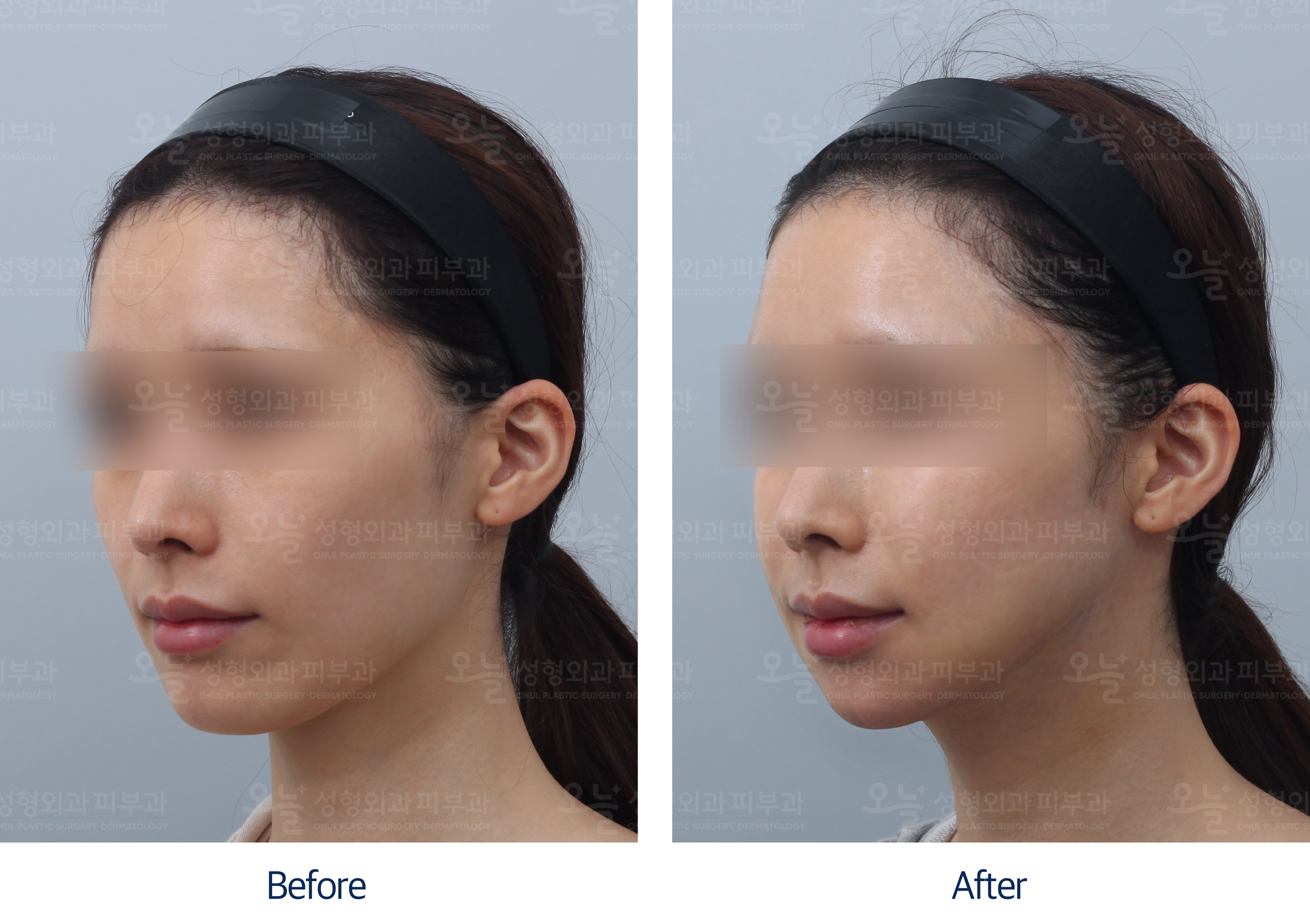 오늘성형외과 전후사진