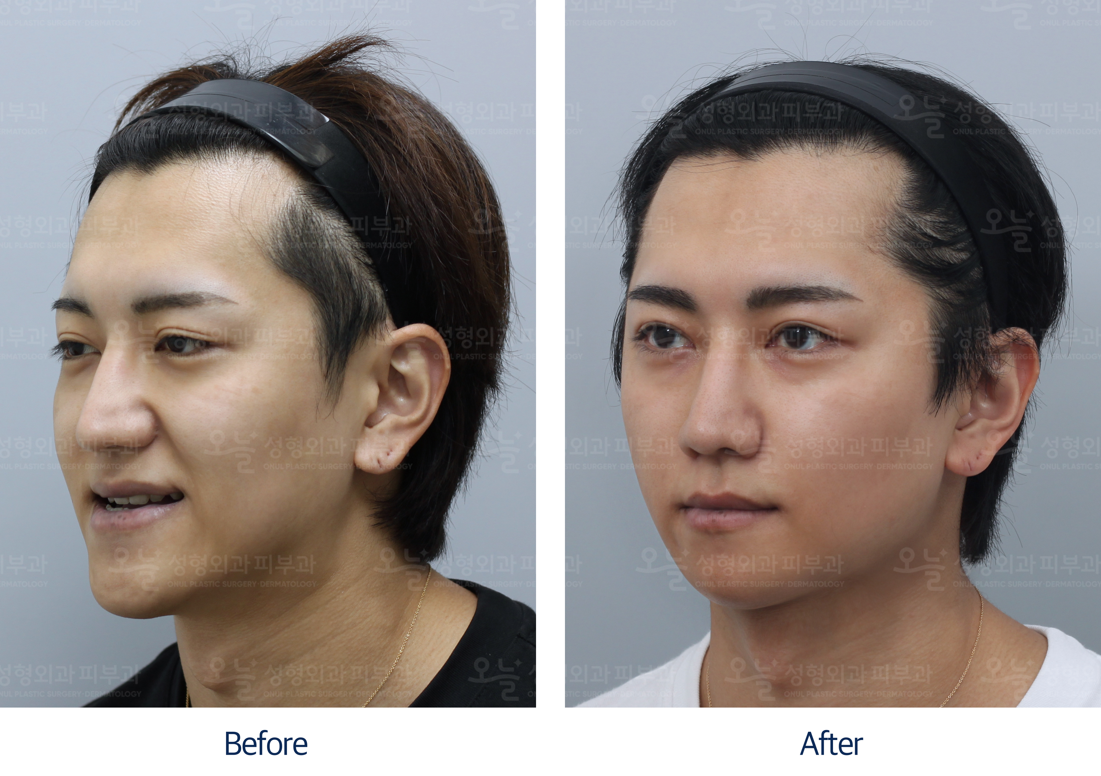 오늘성형외과 전후사진