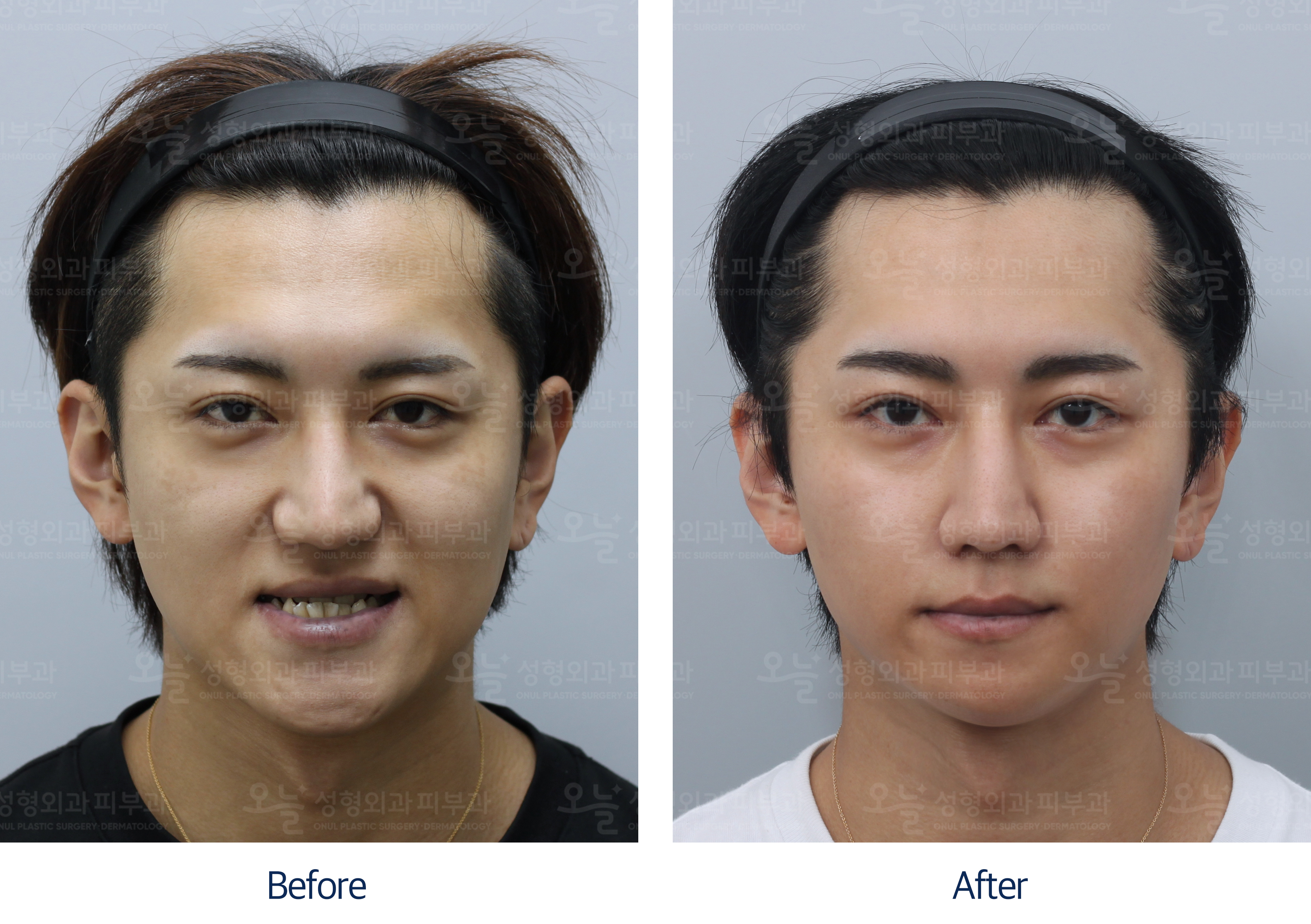 오늘성형외과 전후사진