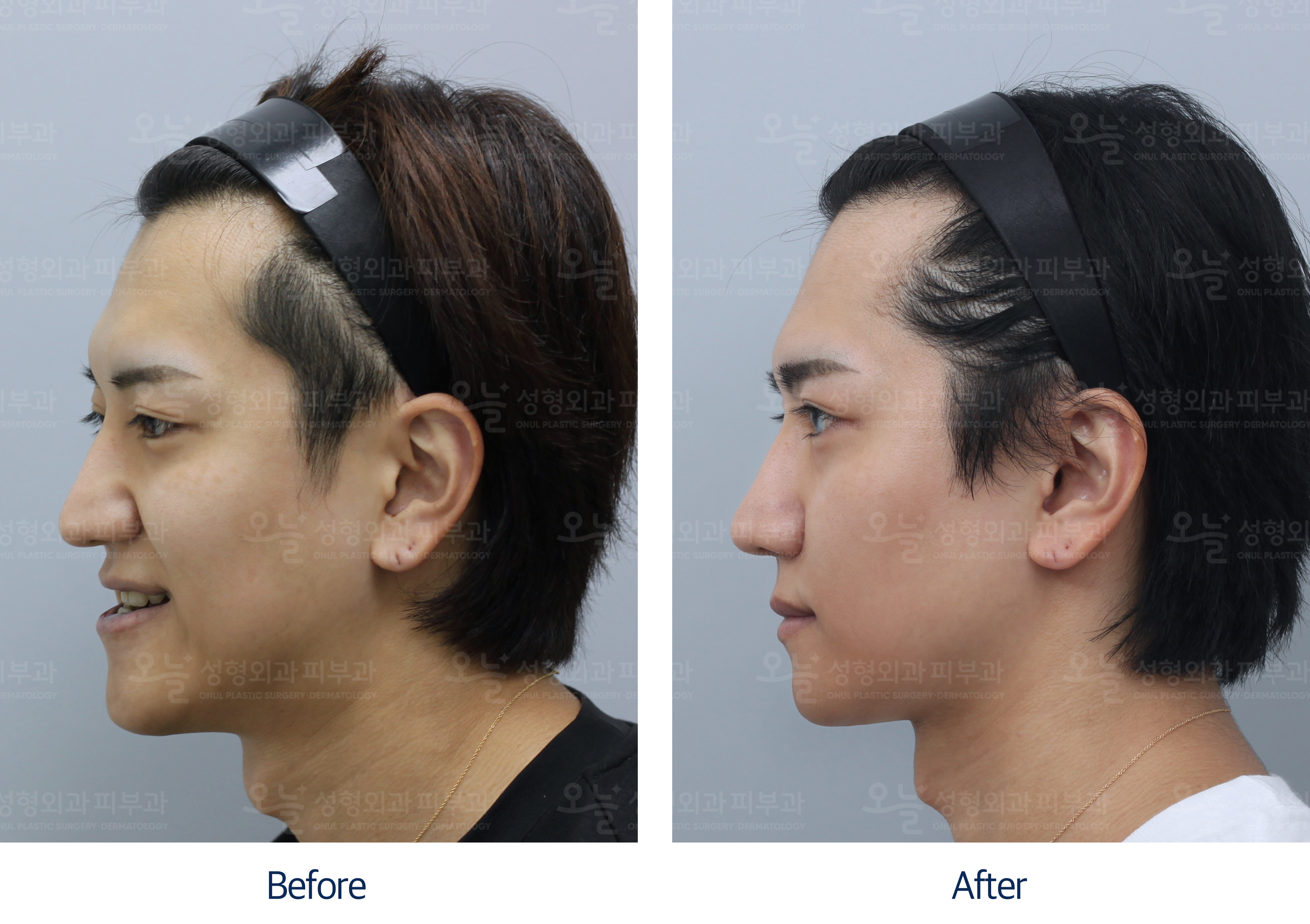 오늘성형외과 전후사진