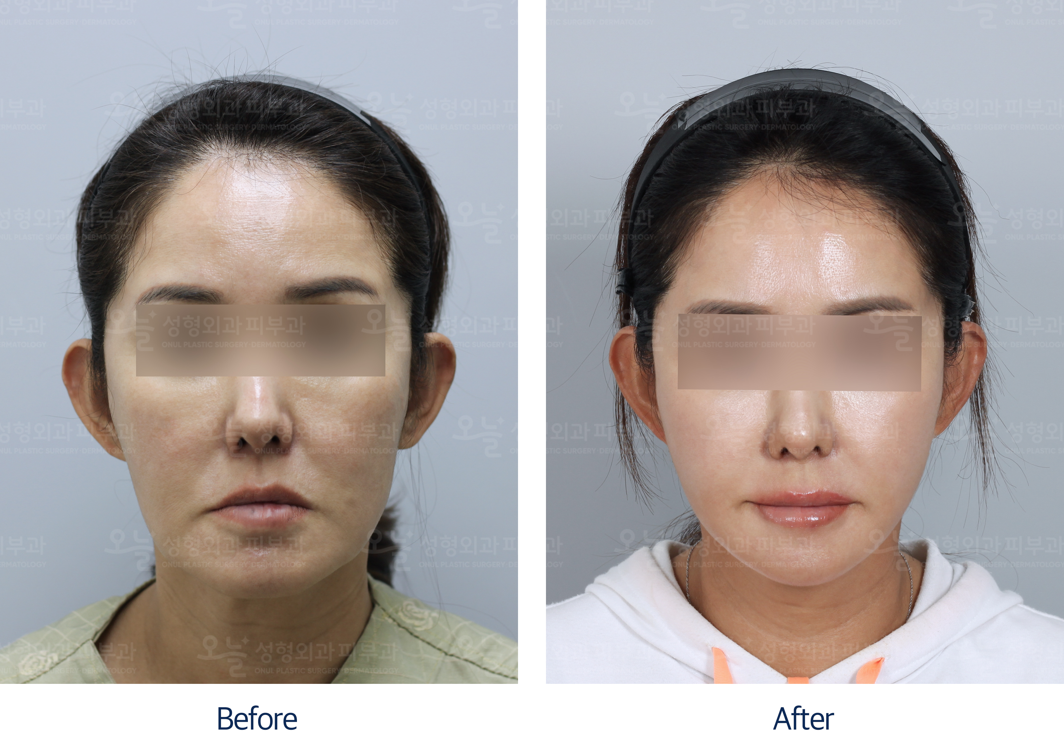 오늘성형외과 전후사진