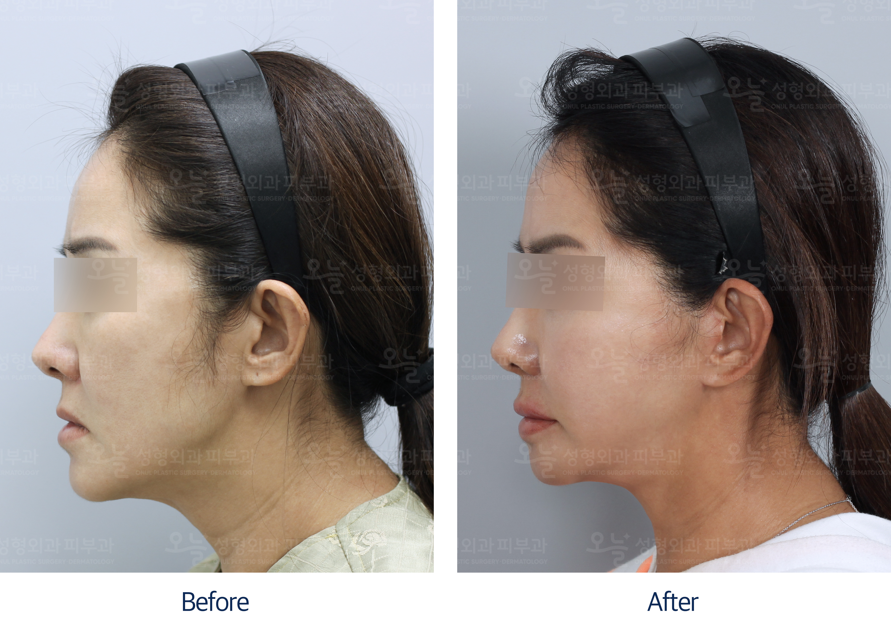 오늘성형외과 전후사진