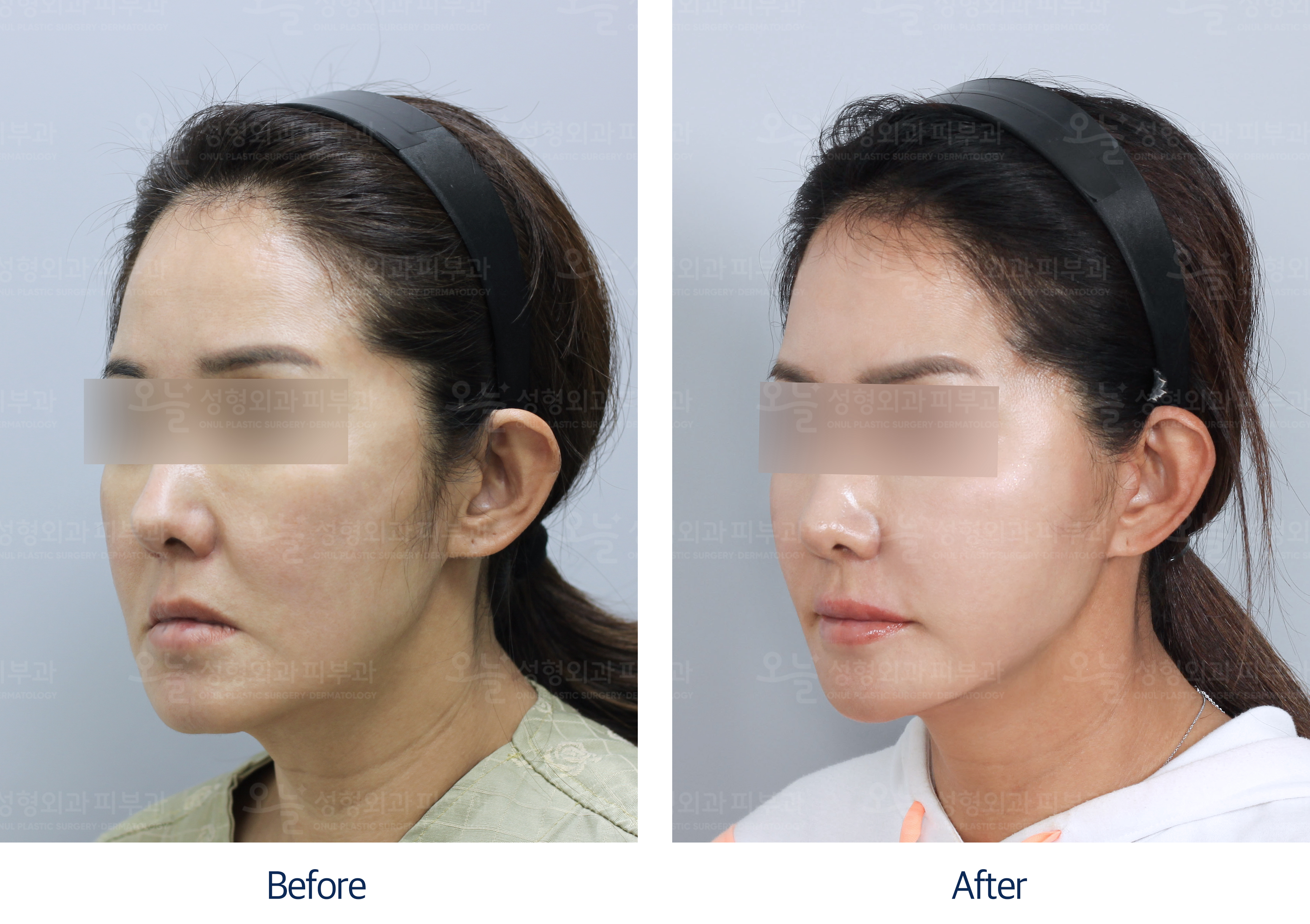 오늘성형외과 전후사진