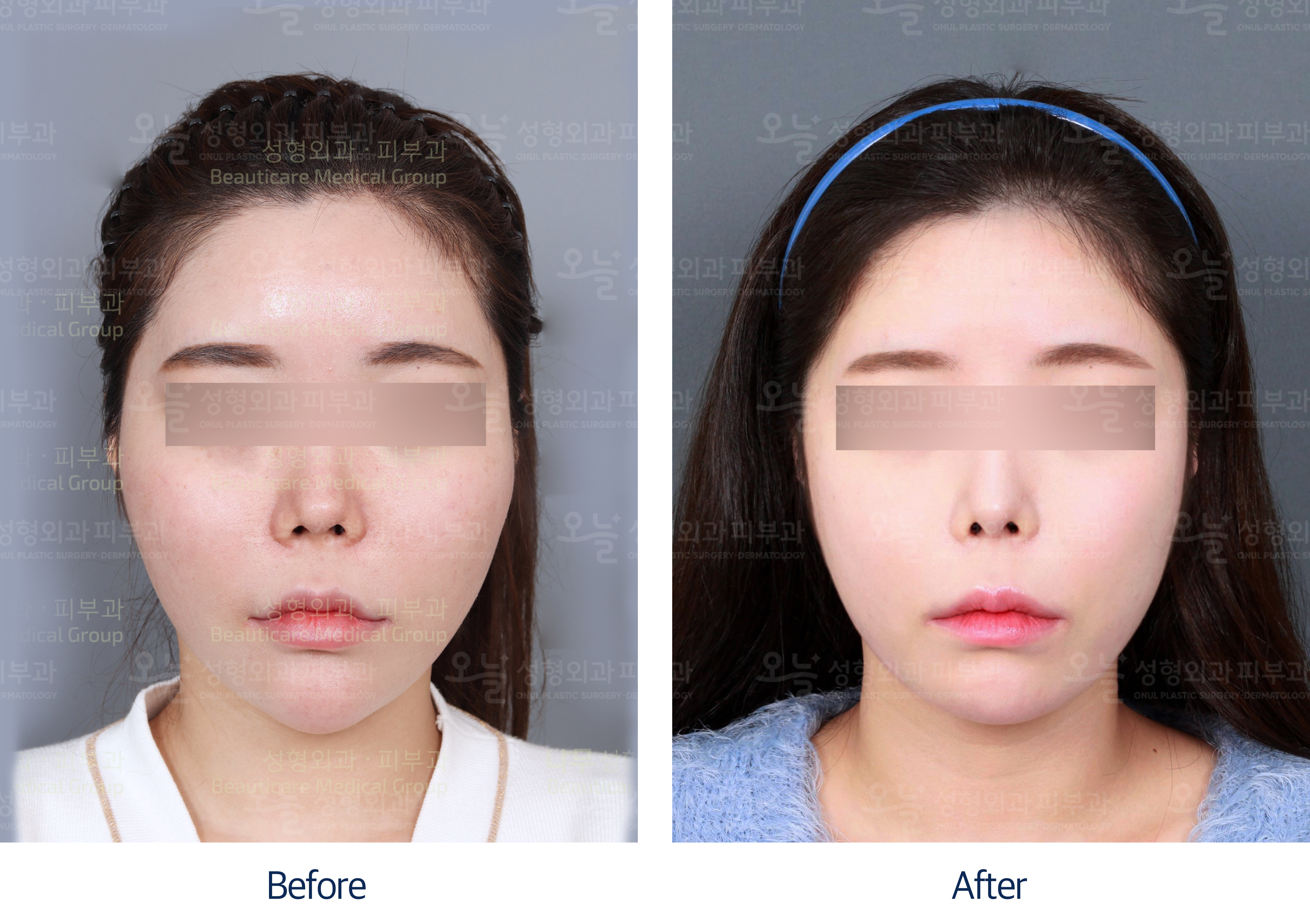 오늘성형외과 전후사진
