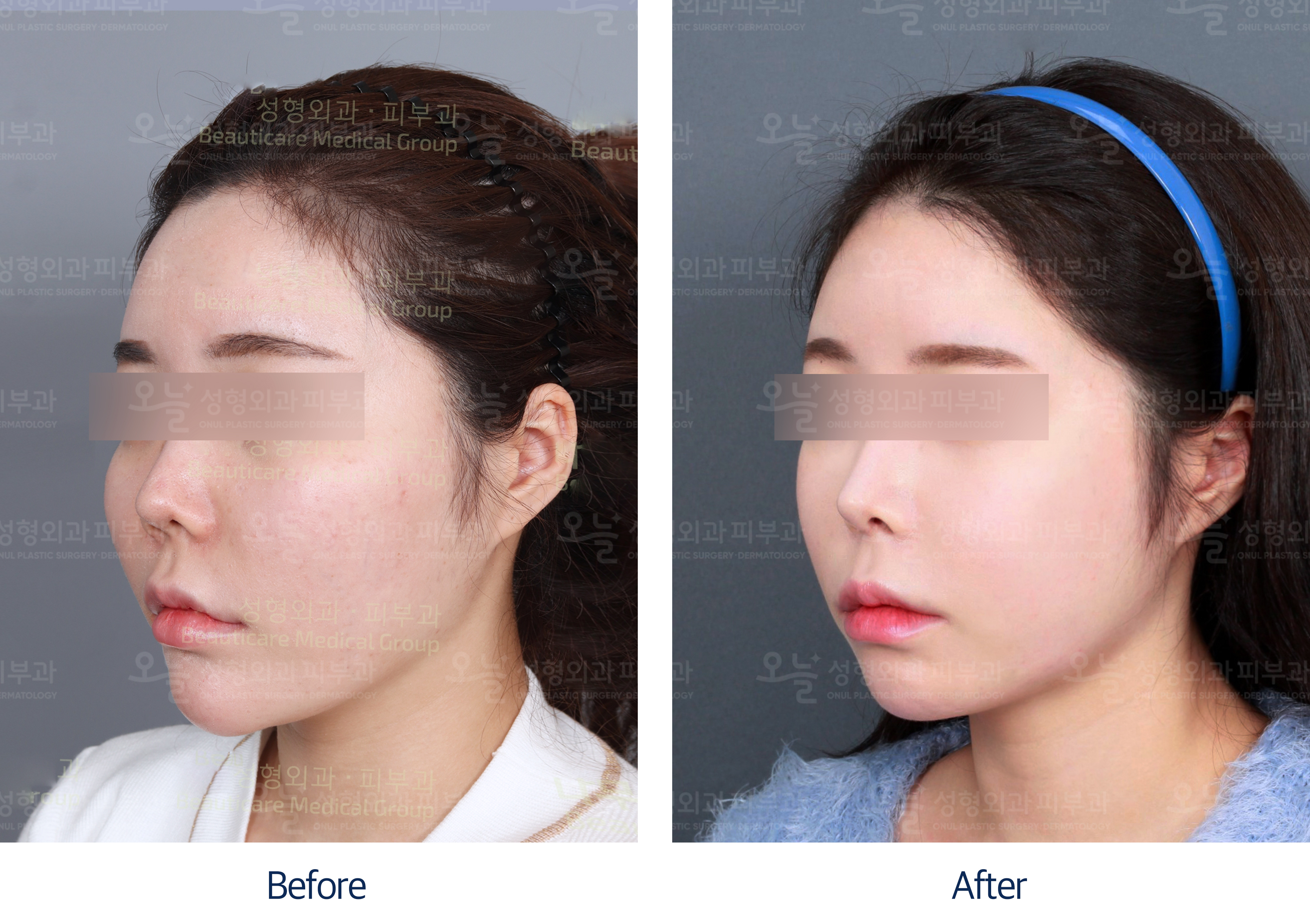 오늘성형외과 전후사진