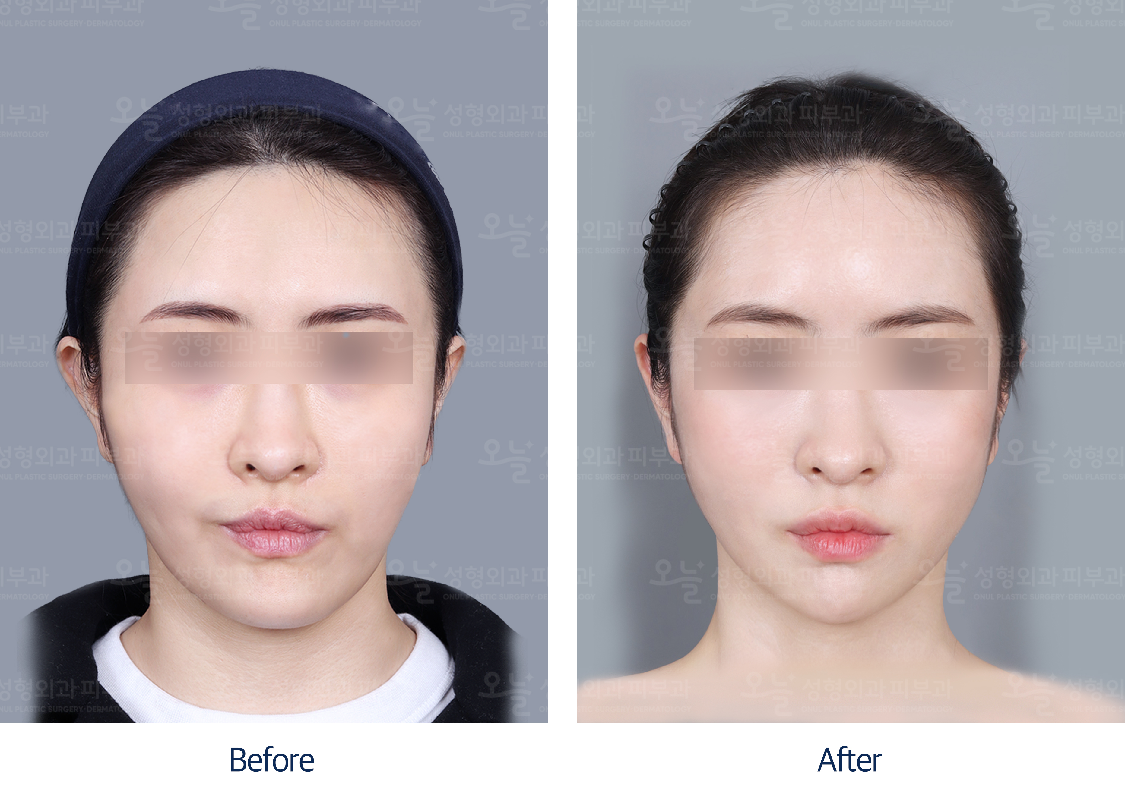 오늘성형외과 전후사진