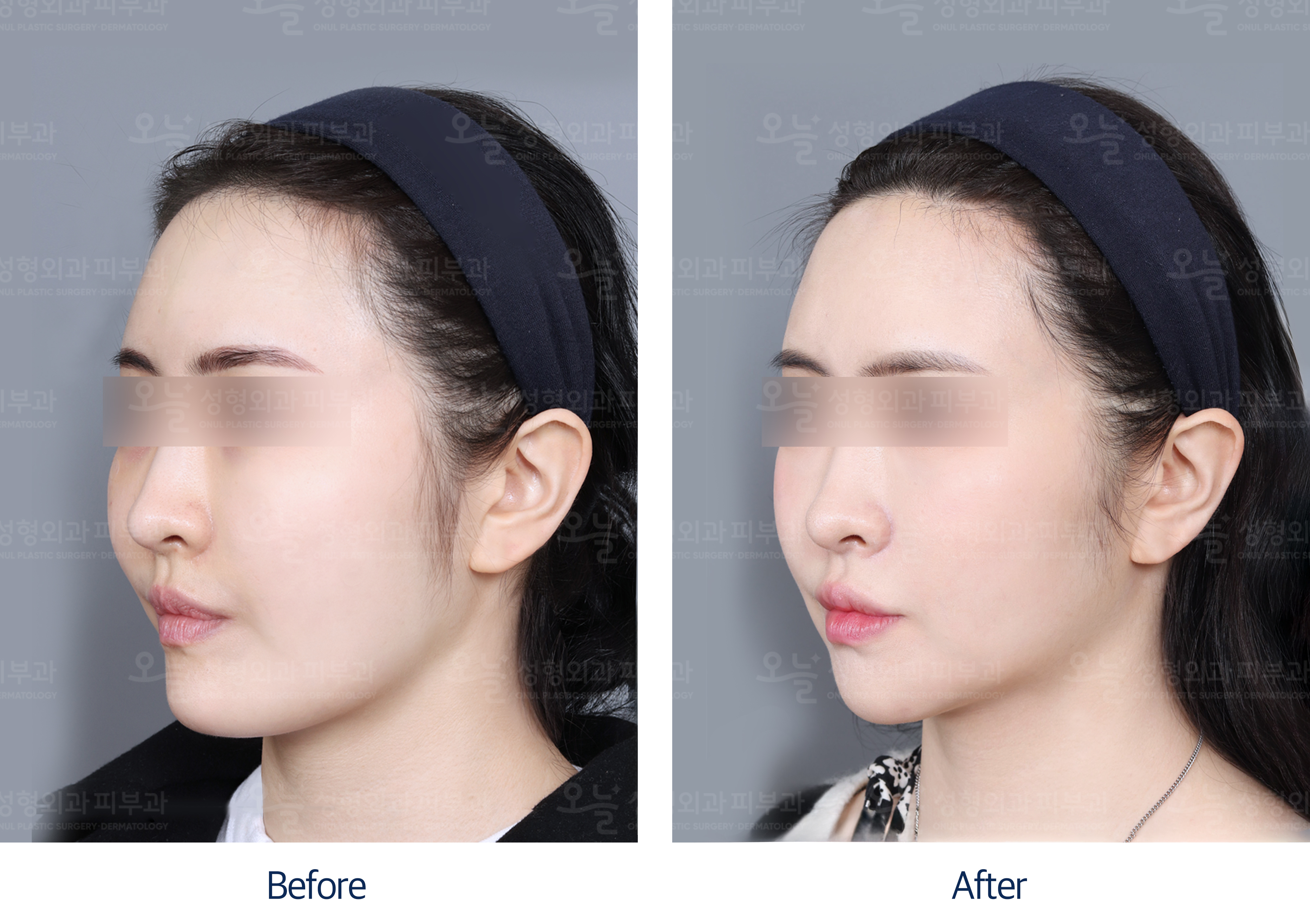 오늘성형외과 전후사진