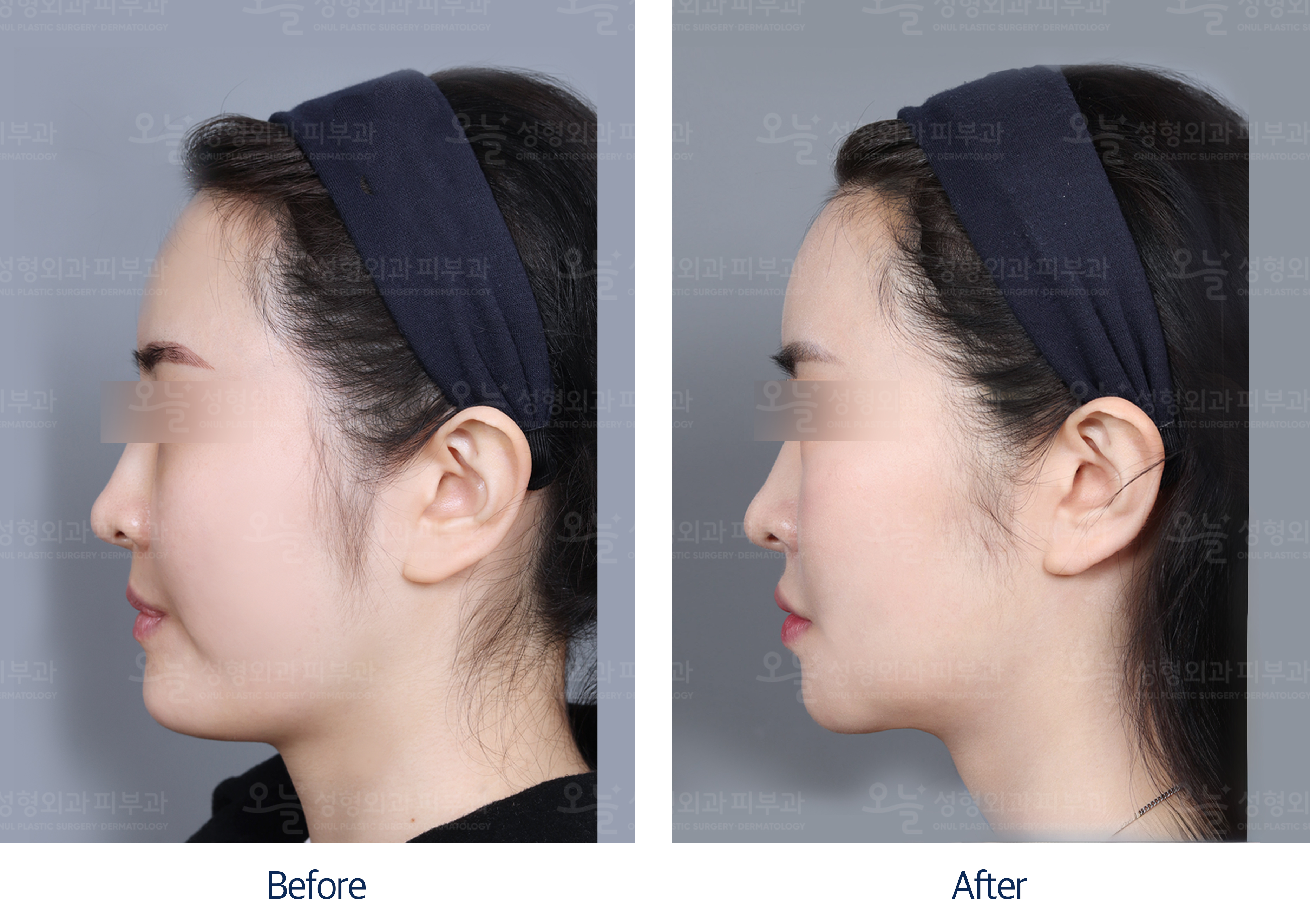 오늘성형외과 전후사진