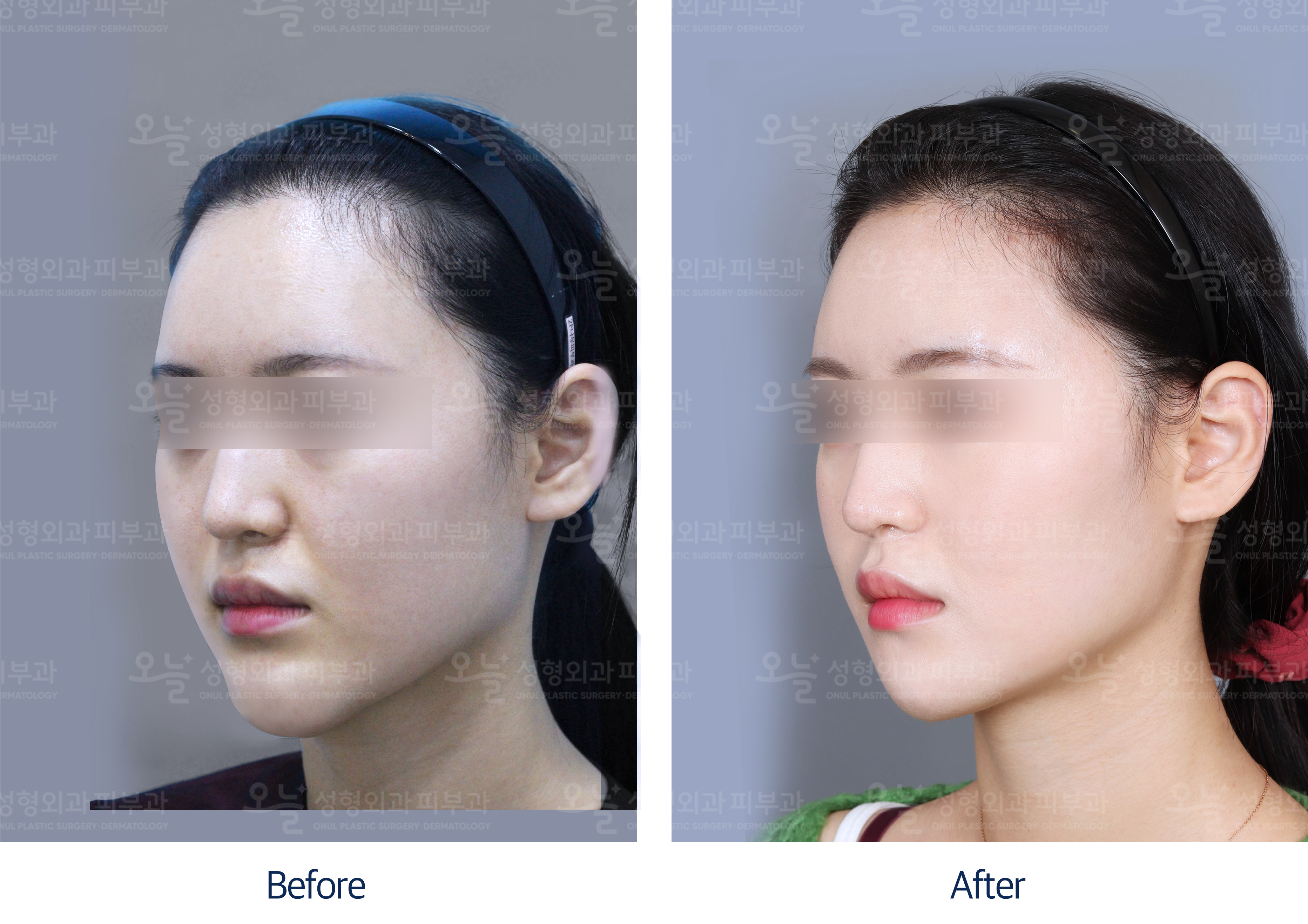 오늘성형외과 전후사진