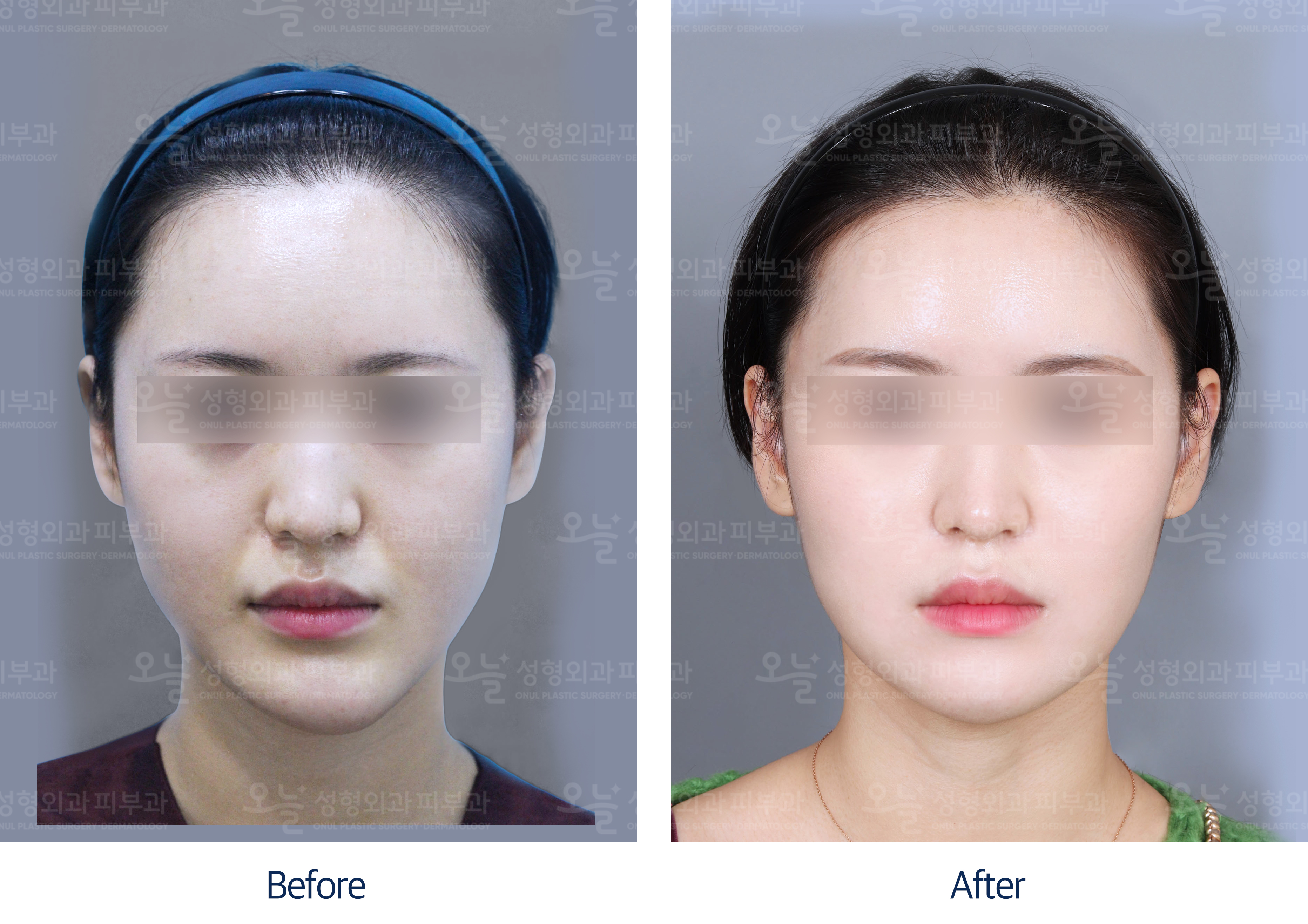 오늘성형외과 전후사진