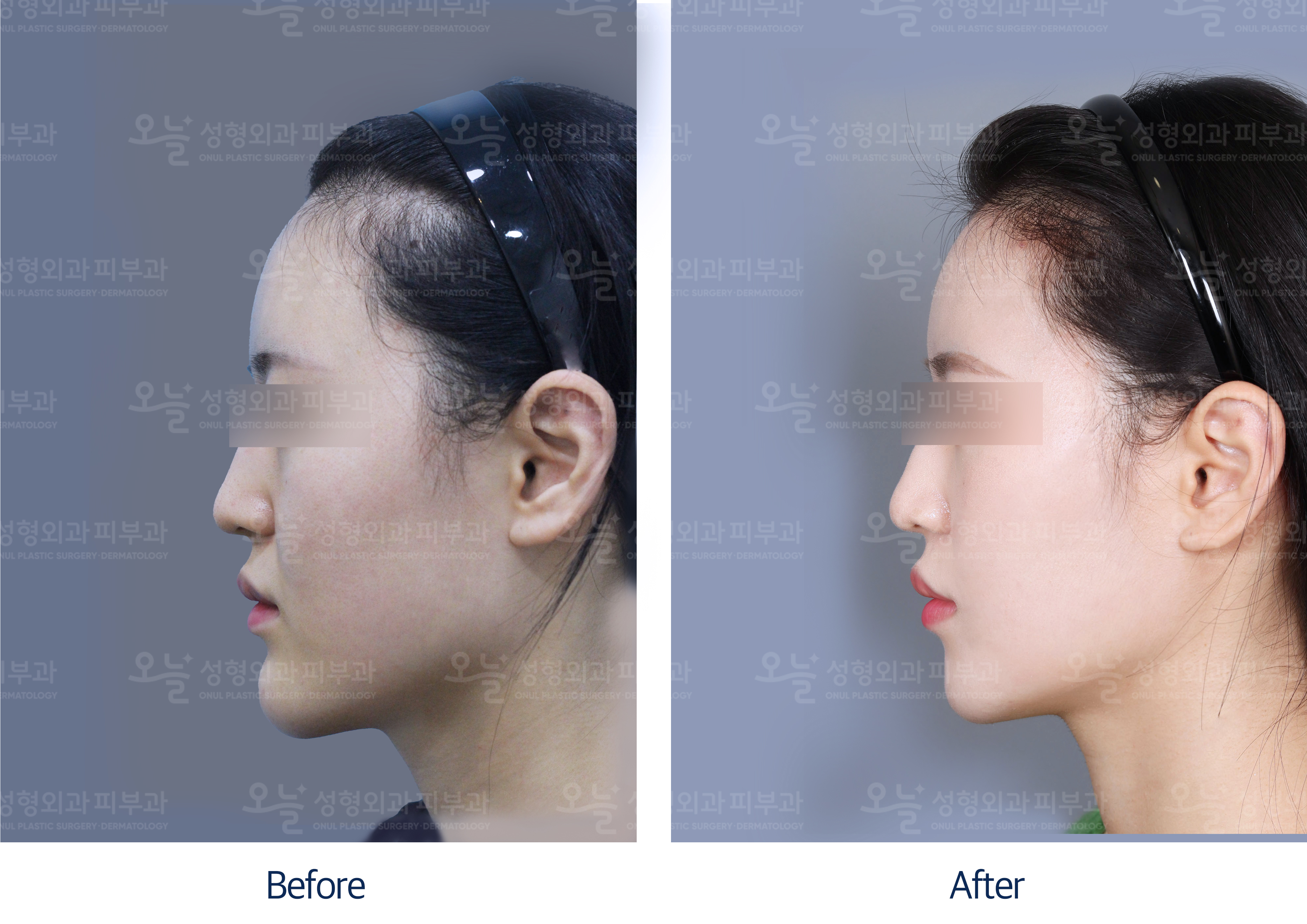 오늘성형외과 전후사진