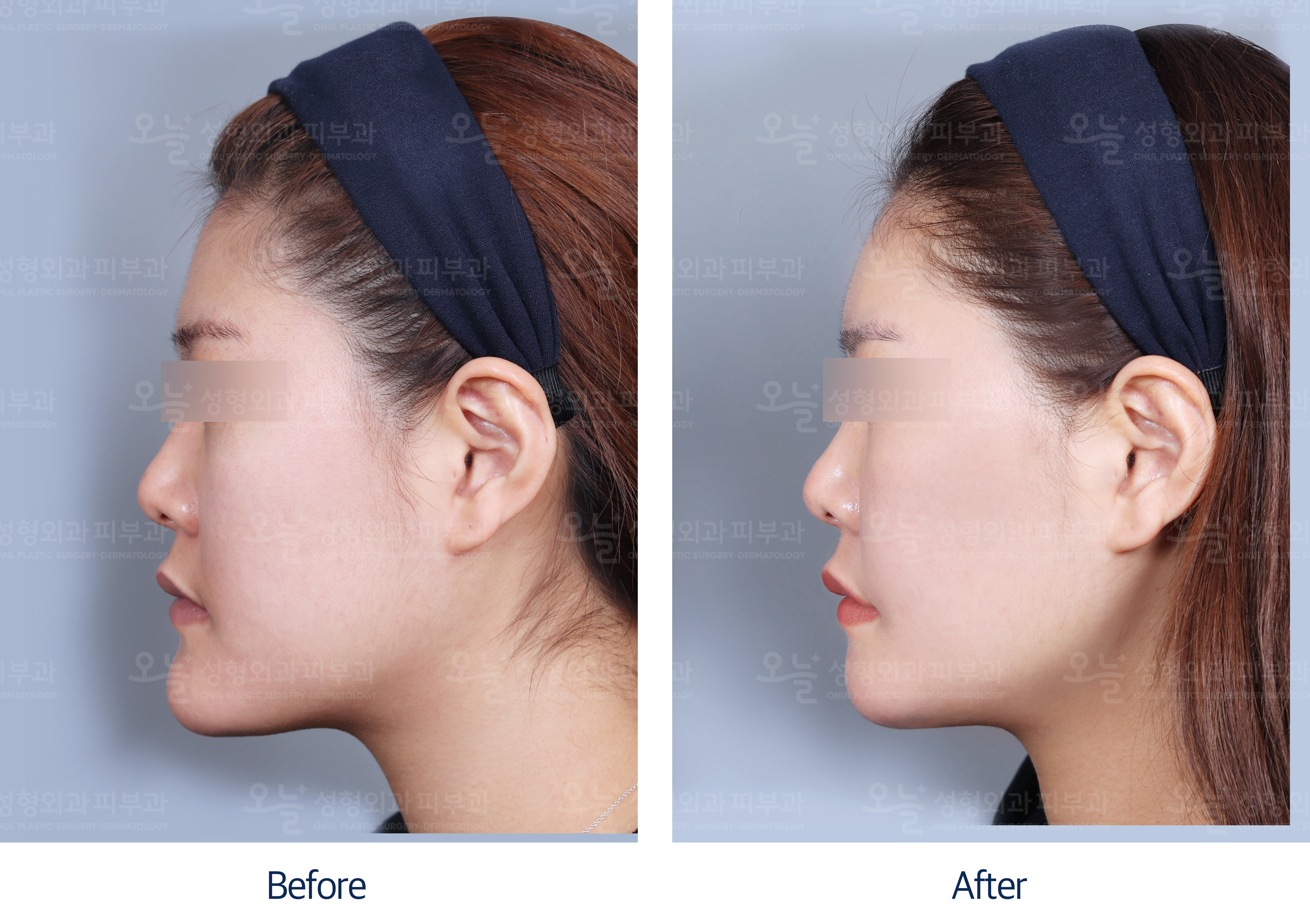 오늘성형외과 전후사진