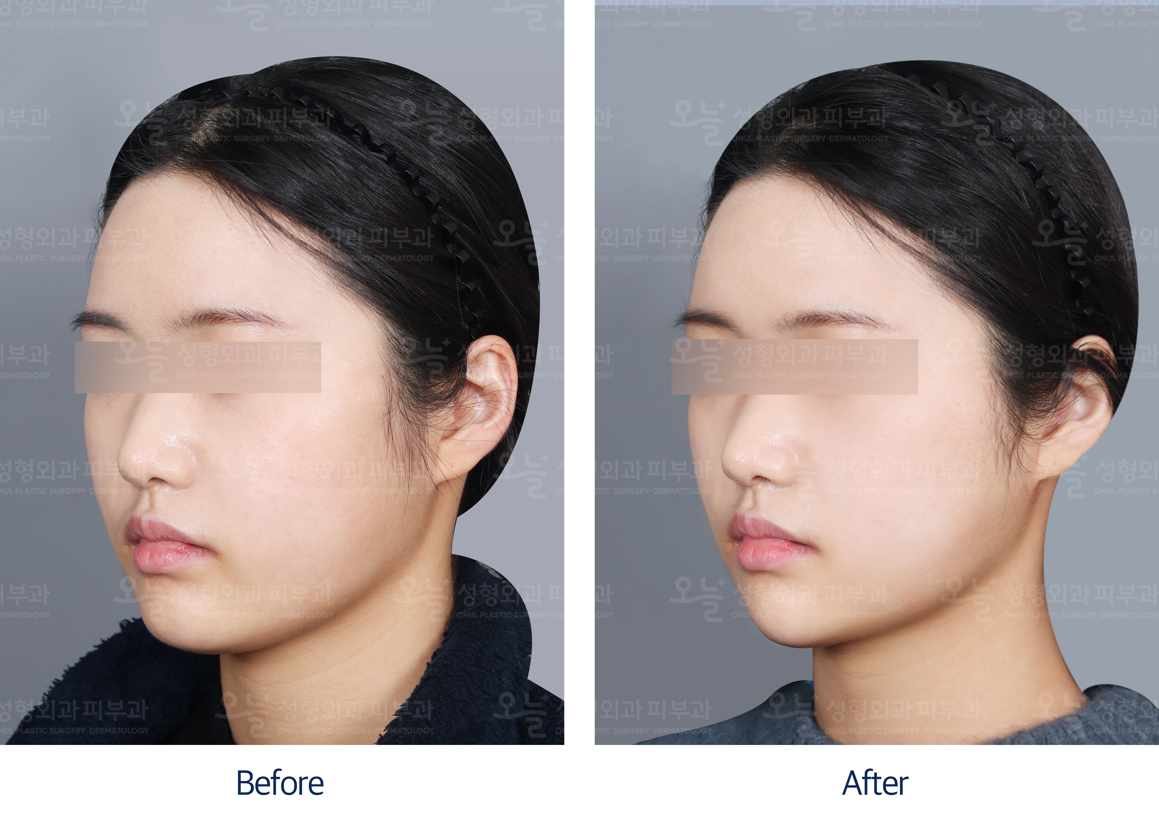 오늘성형외과 전후사진