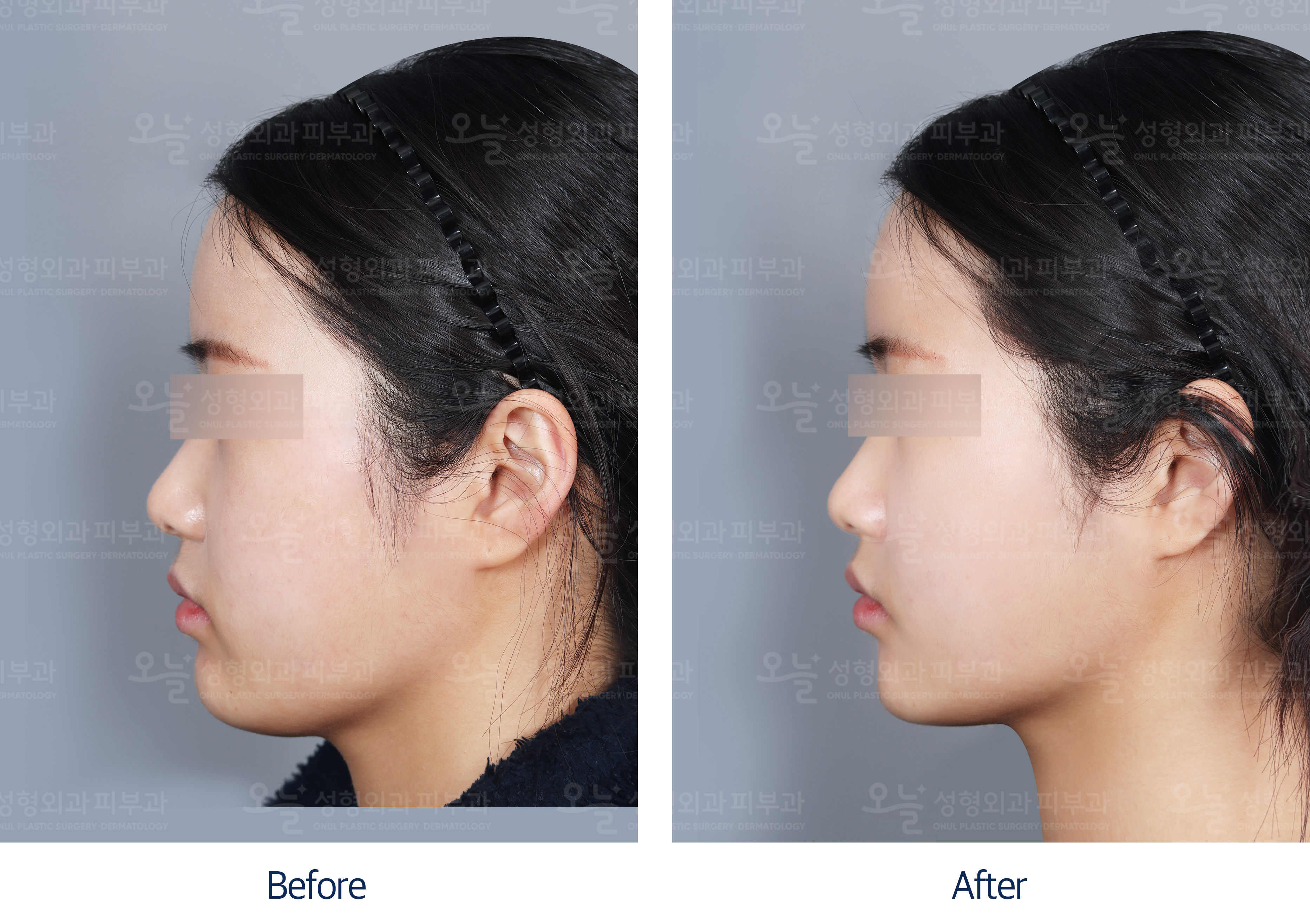 오늘성형외과 전후사진