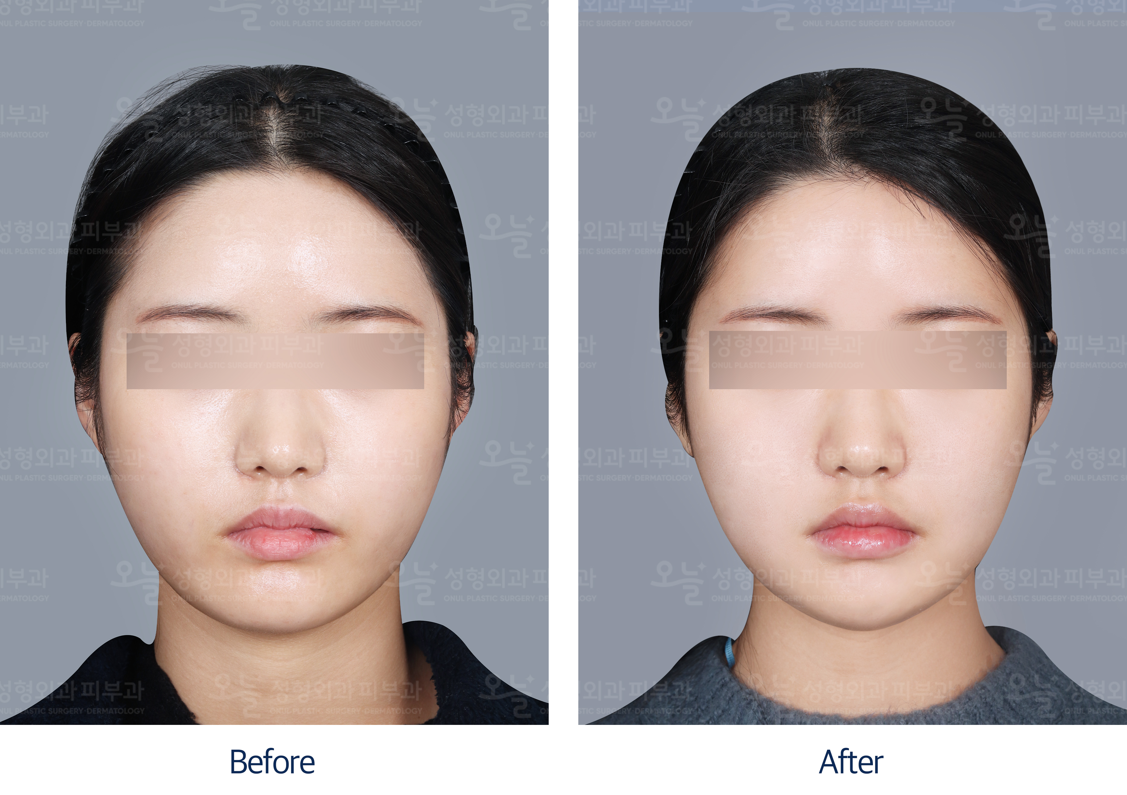오늘성형외과 전후사진