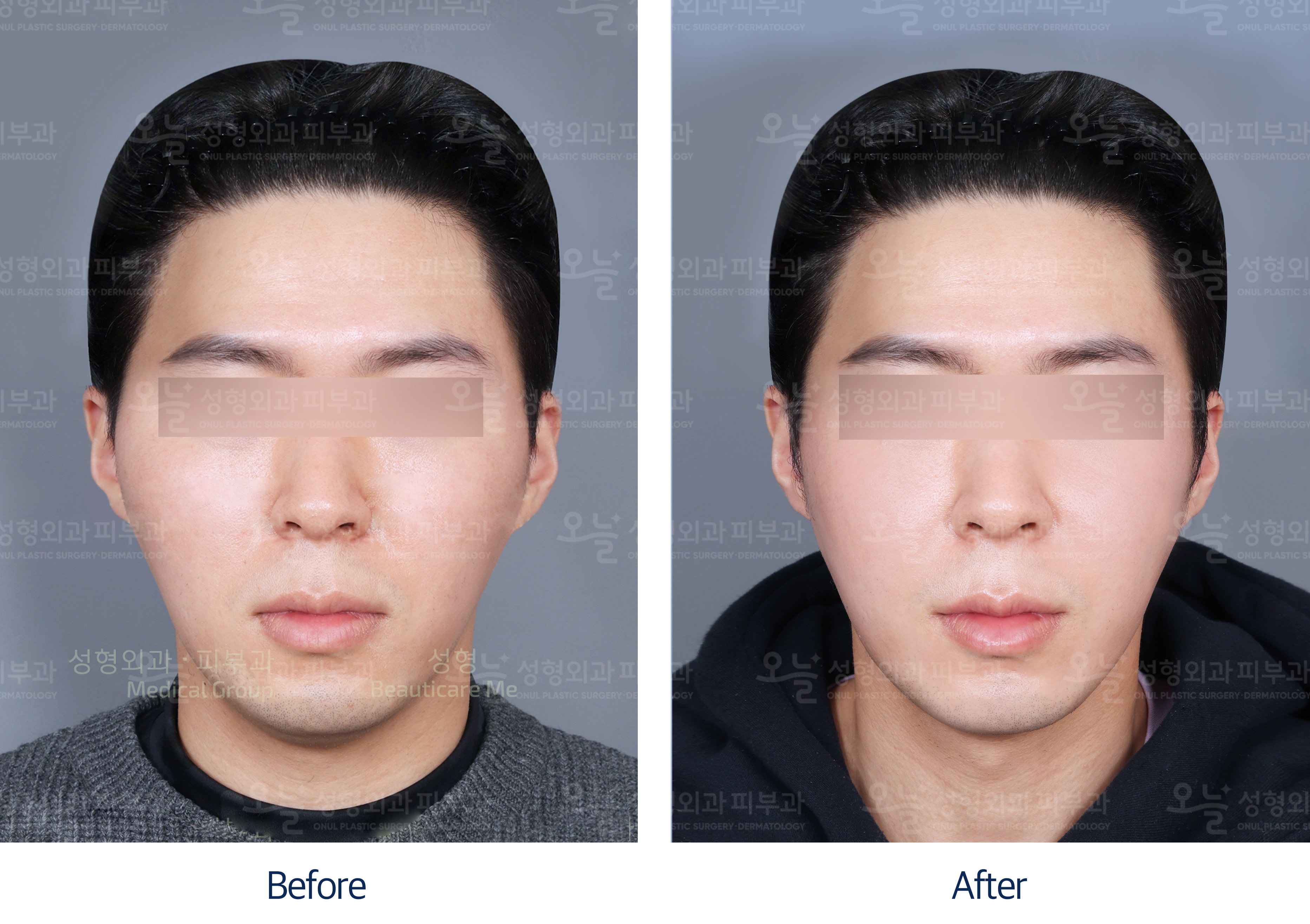 오늘성형외과 전후사진