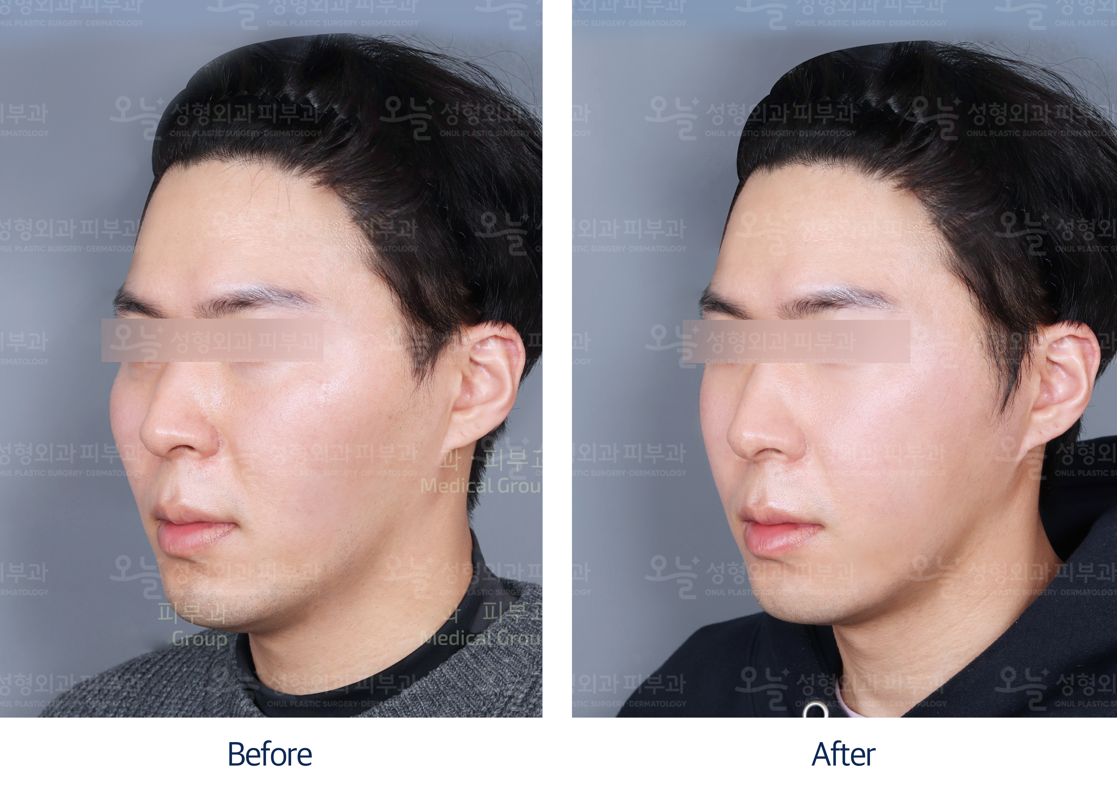 오늘성형외과 전후사진