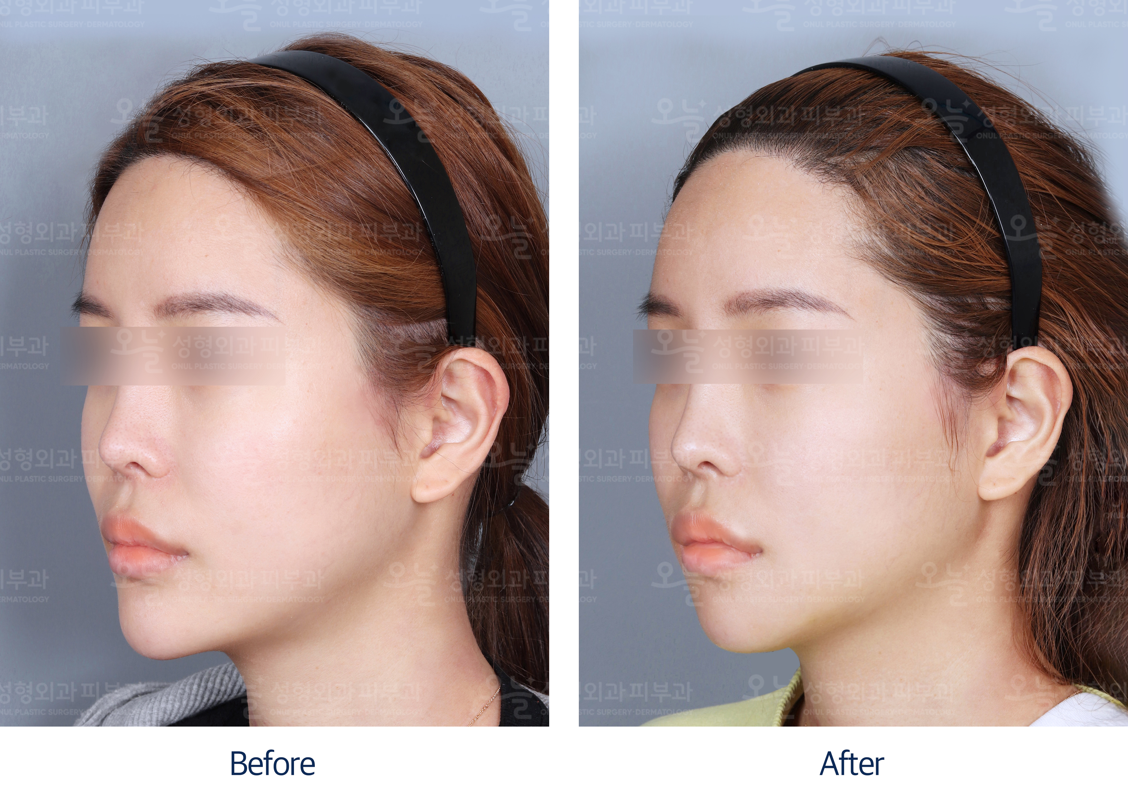 오늘성형외과 전후사진