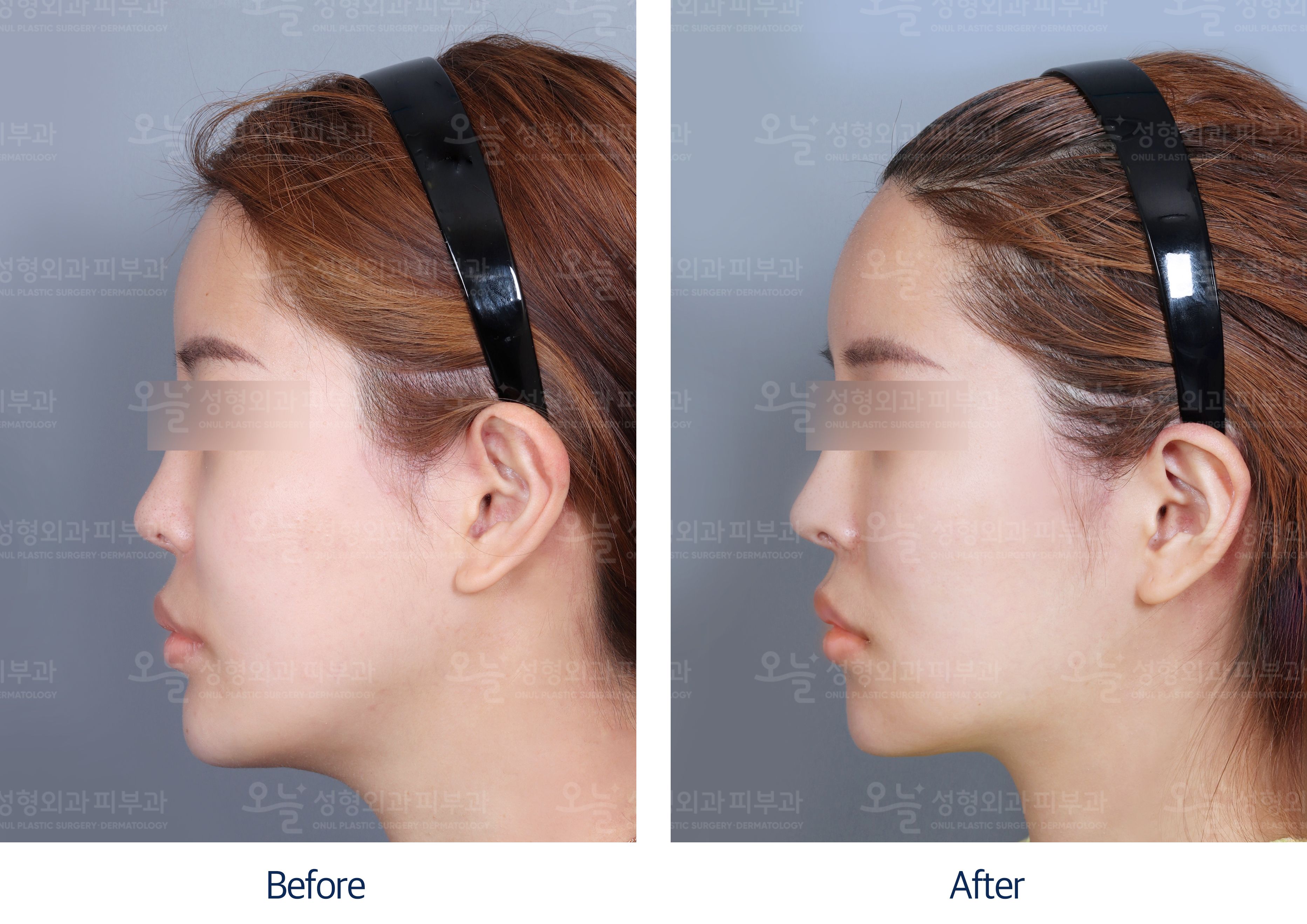 오늘성형외과 전후사진