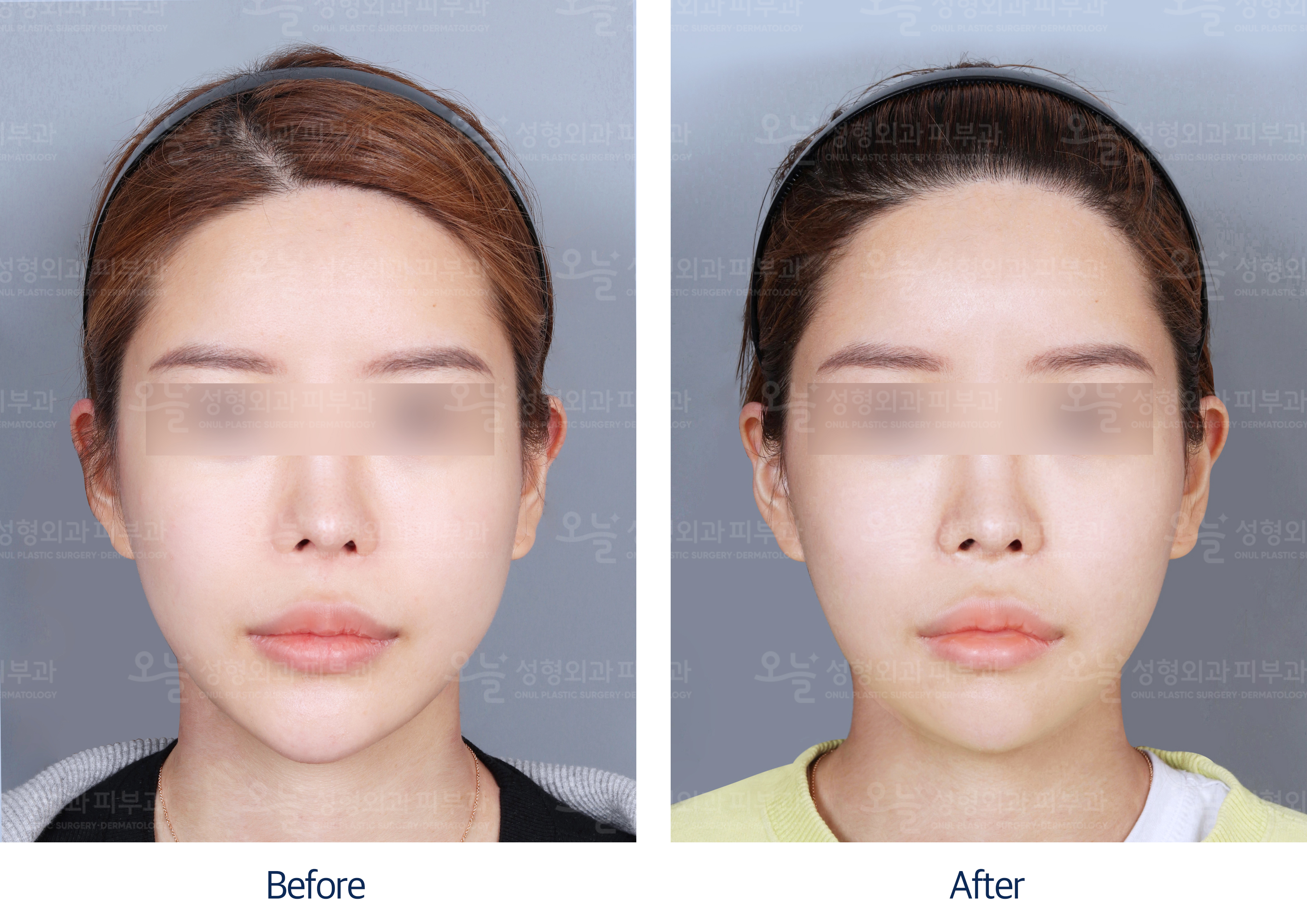 오늘성형외과 전후사진