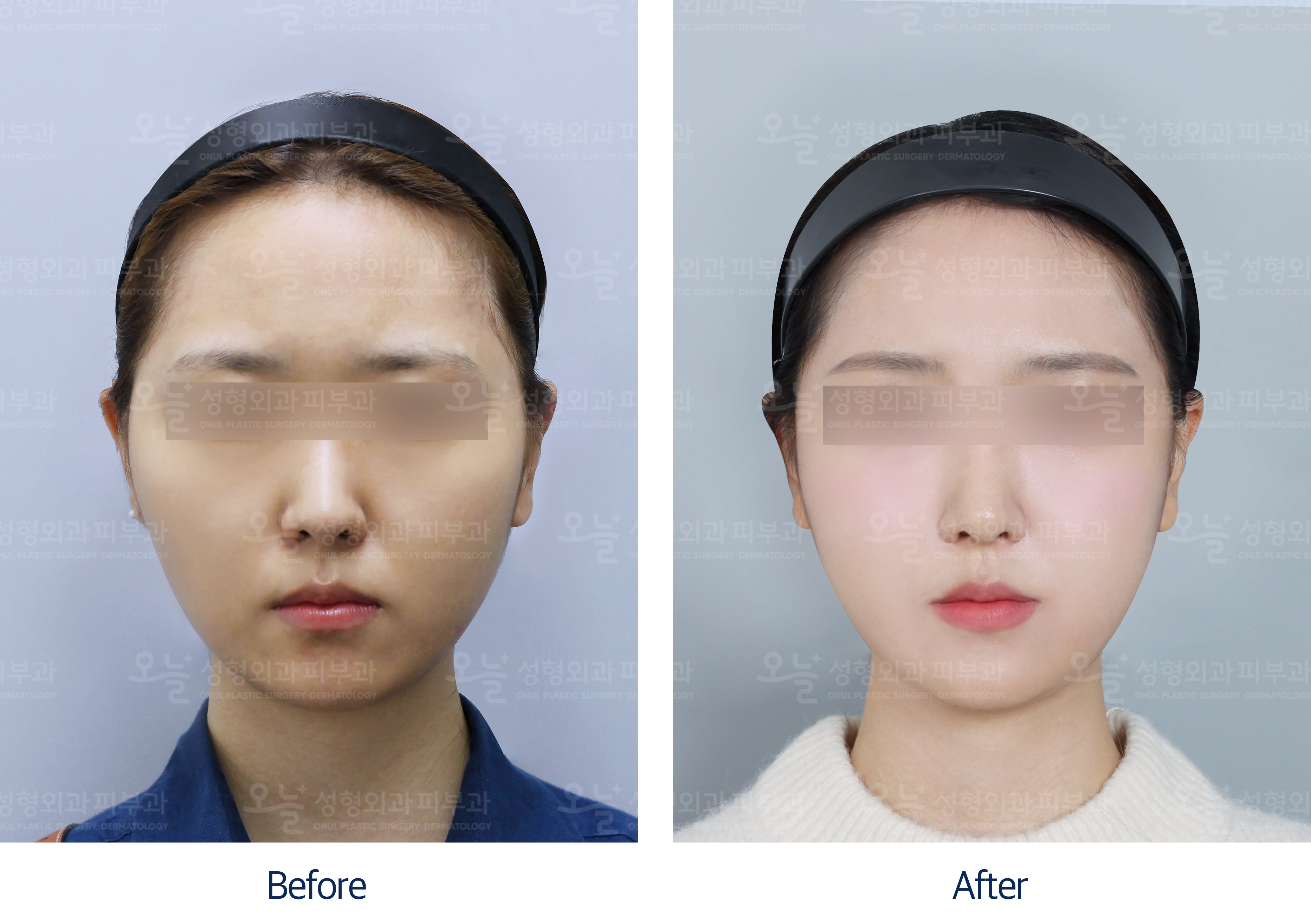 오늘성형외과 전후사진