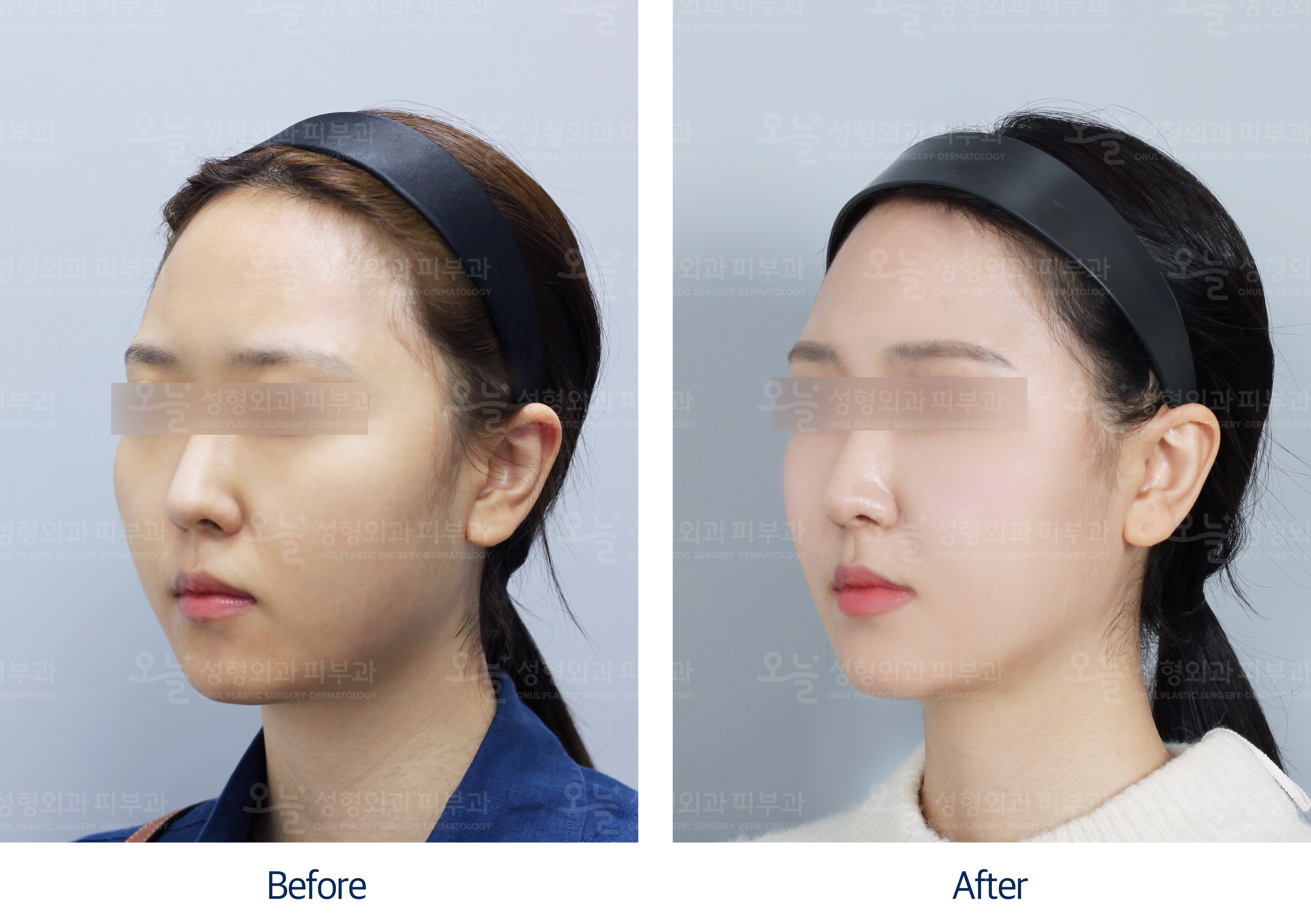 오늘성형외과 전후사진
