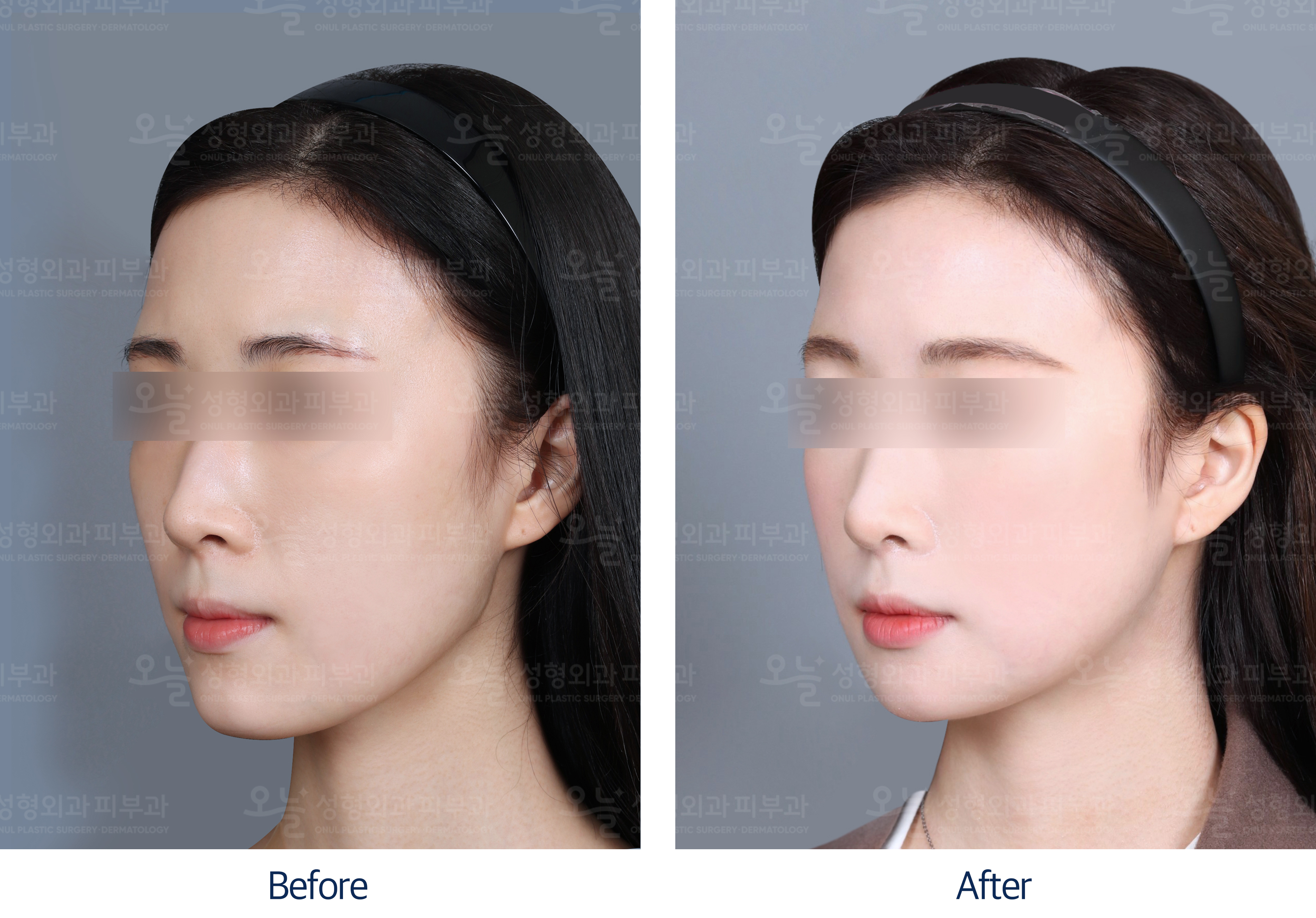 오늘성형외과 전후사진