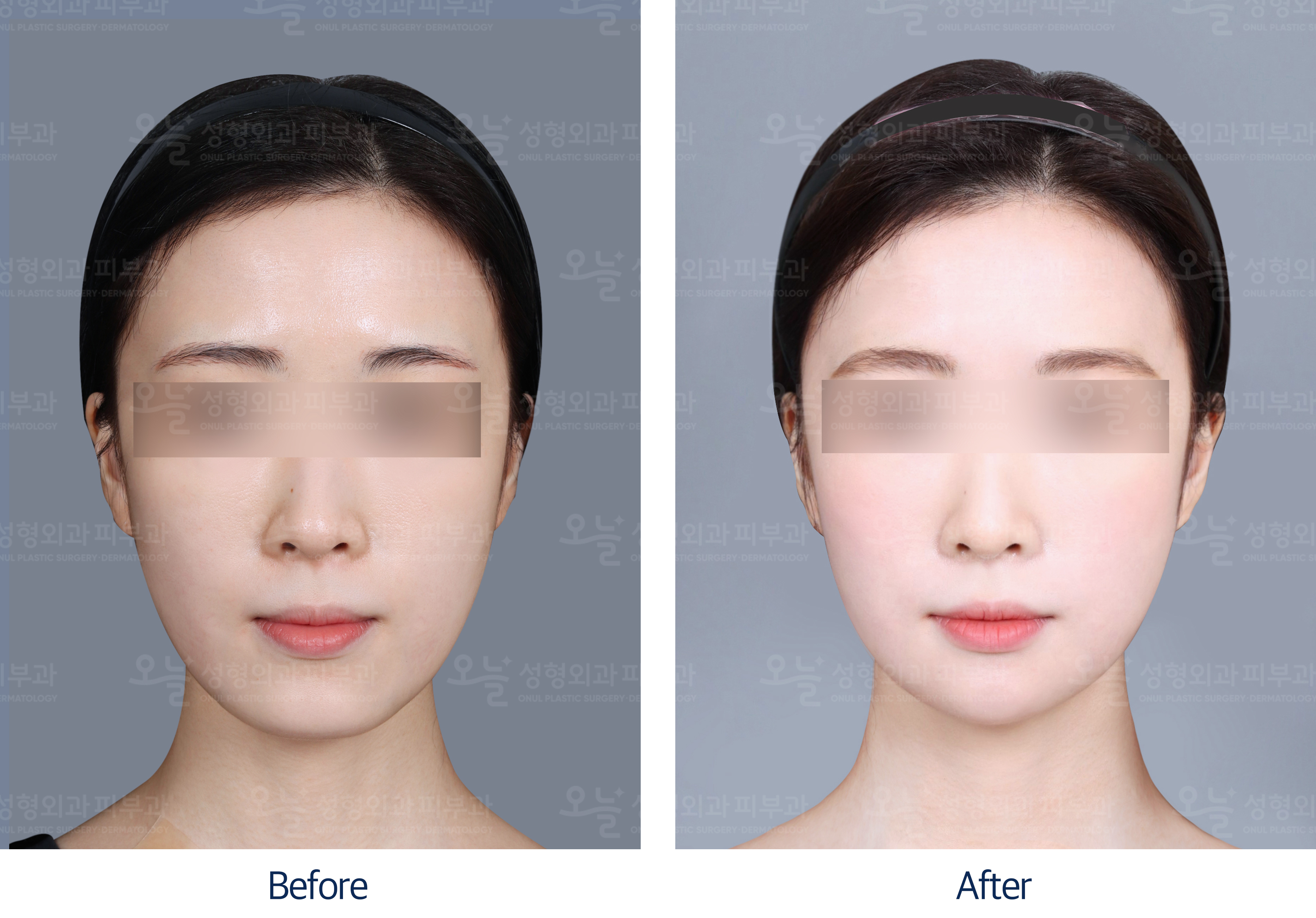 오늘성형외과 전후사진