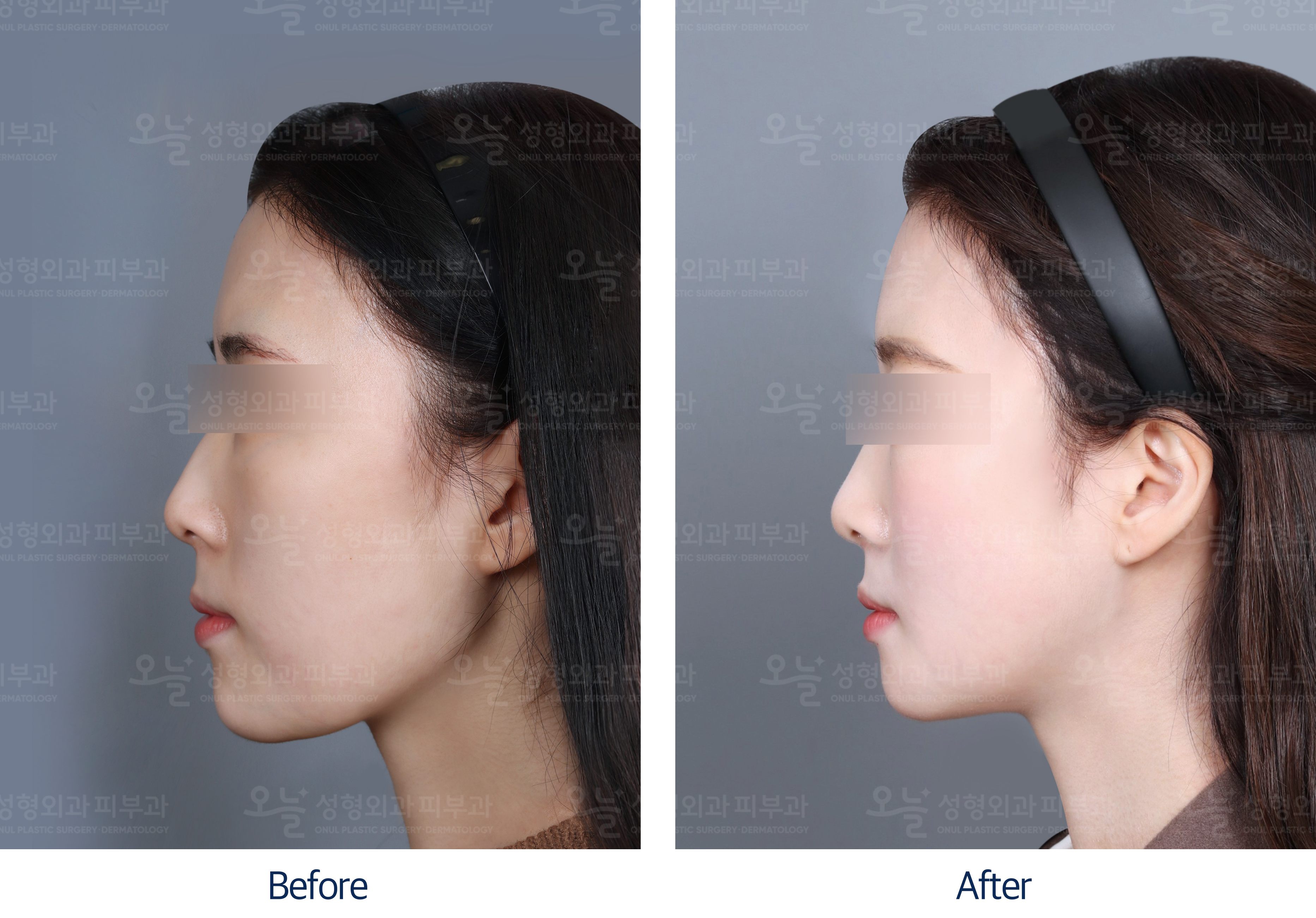 오늘성형외과 전후사진