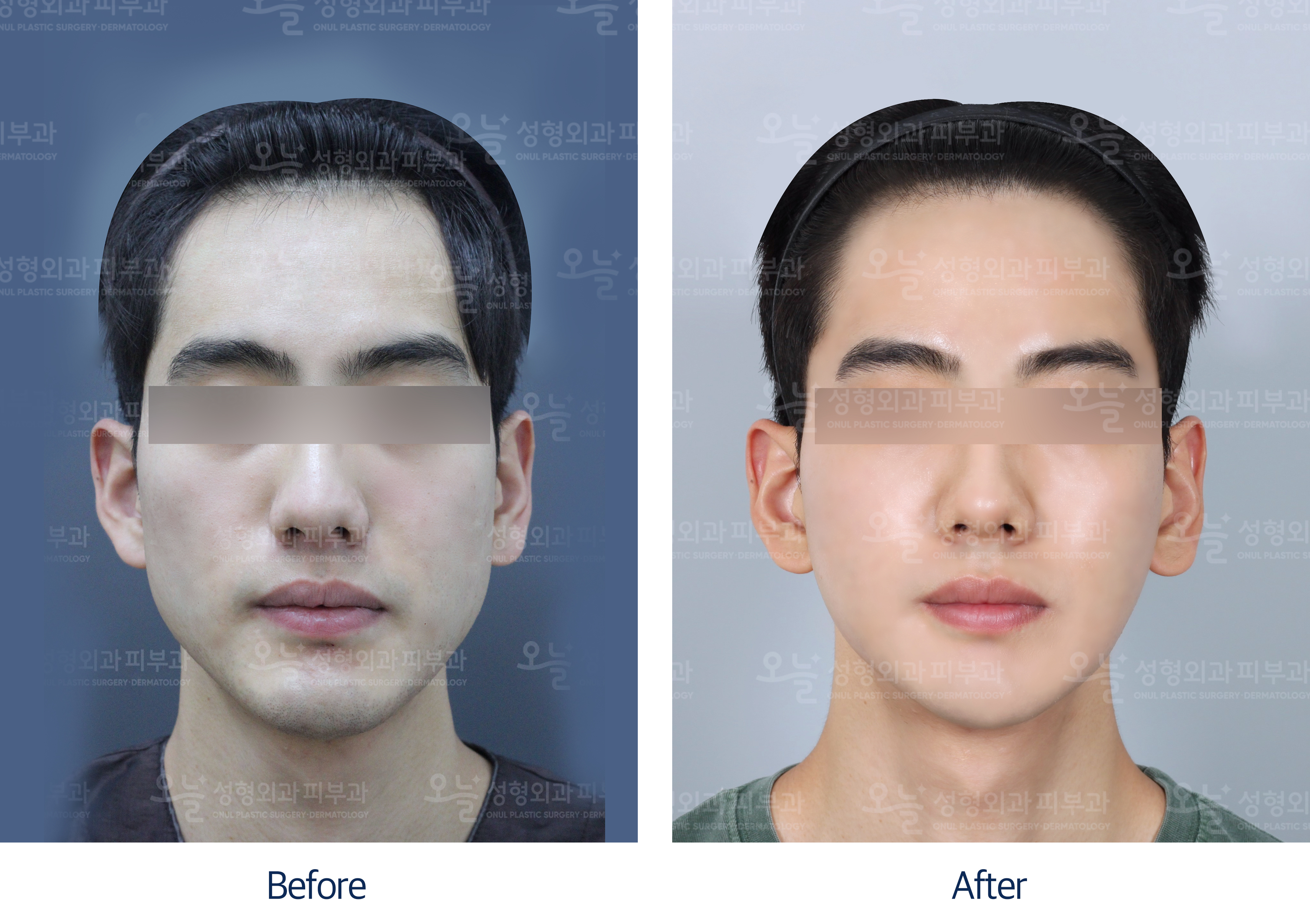 오늘성형외과 전후사진