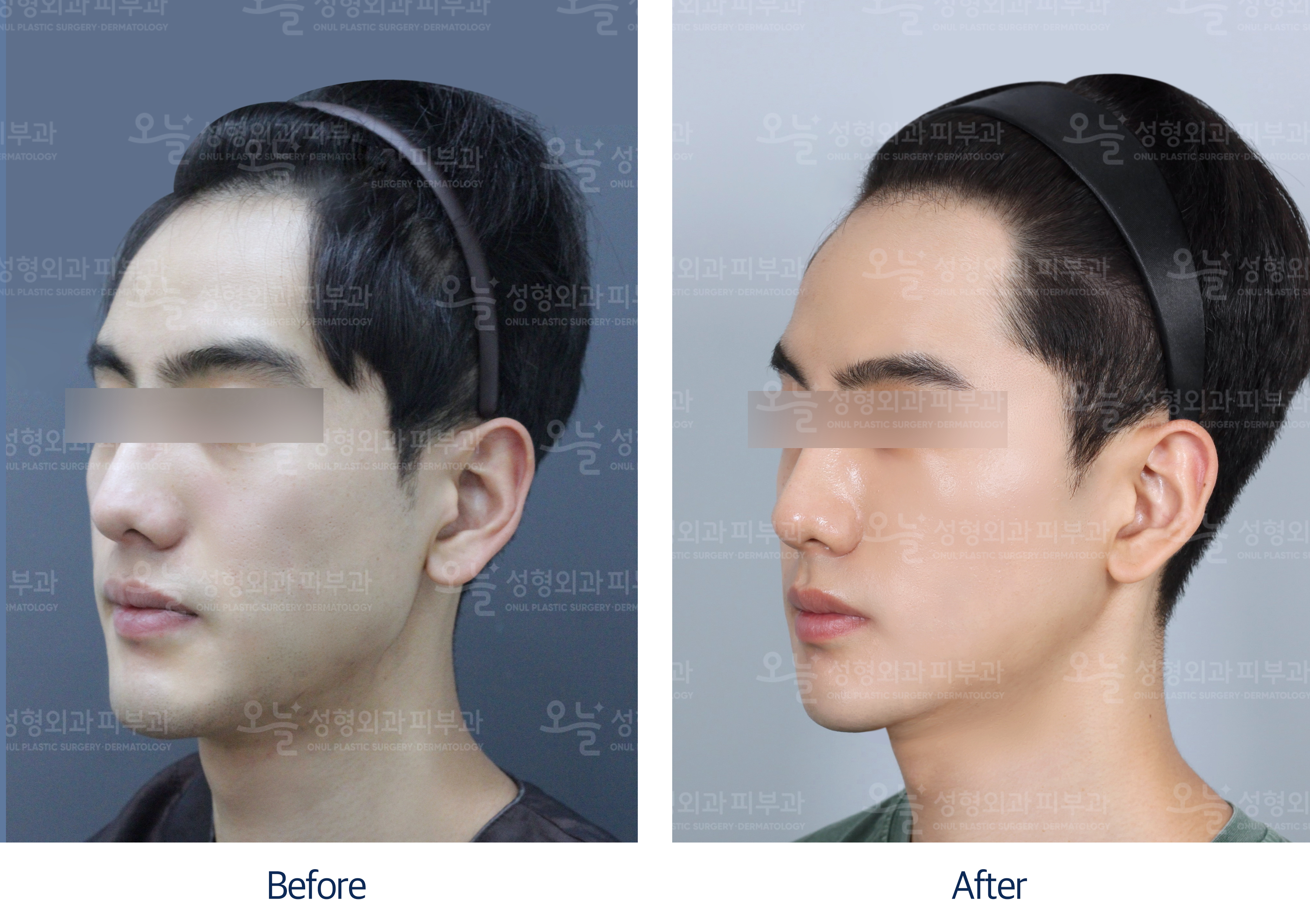 오늘성형외과 전후사진