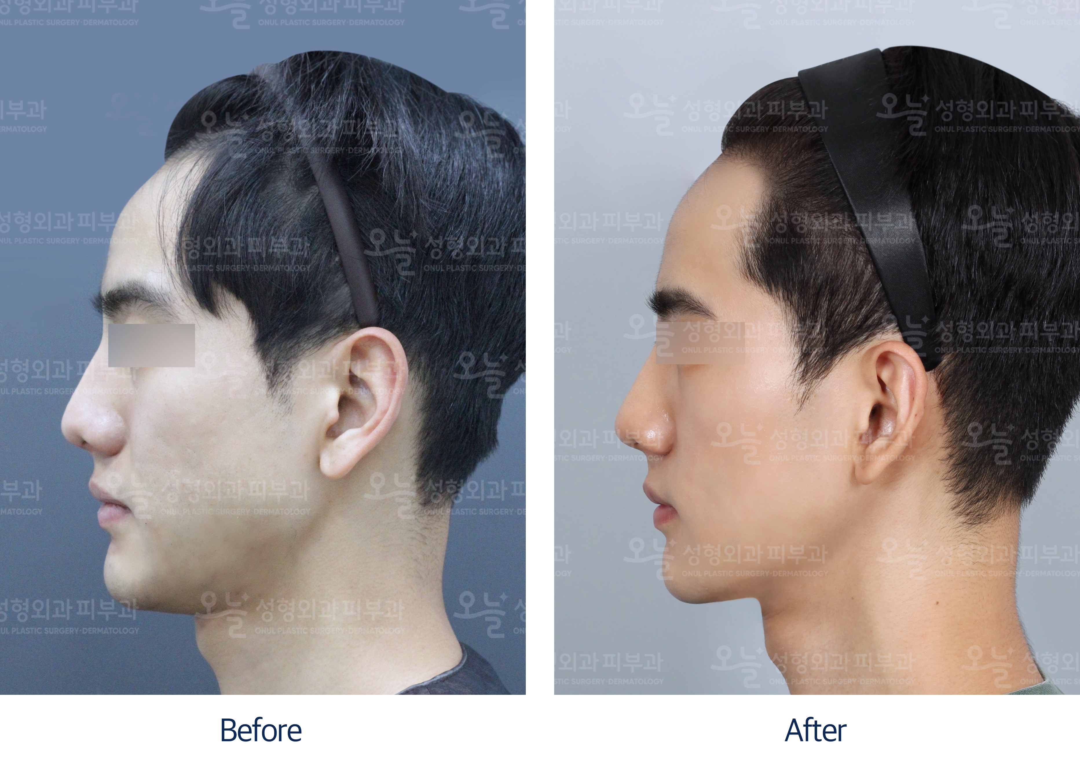 오늘성형외과 전후사진