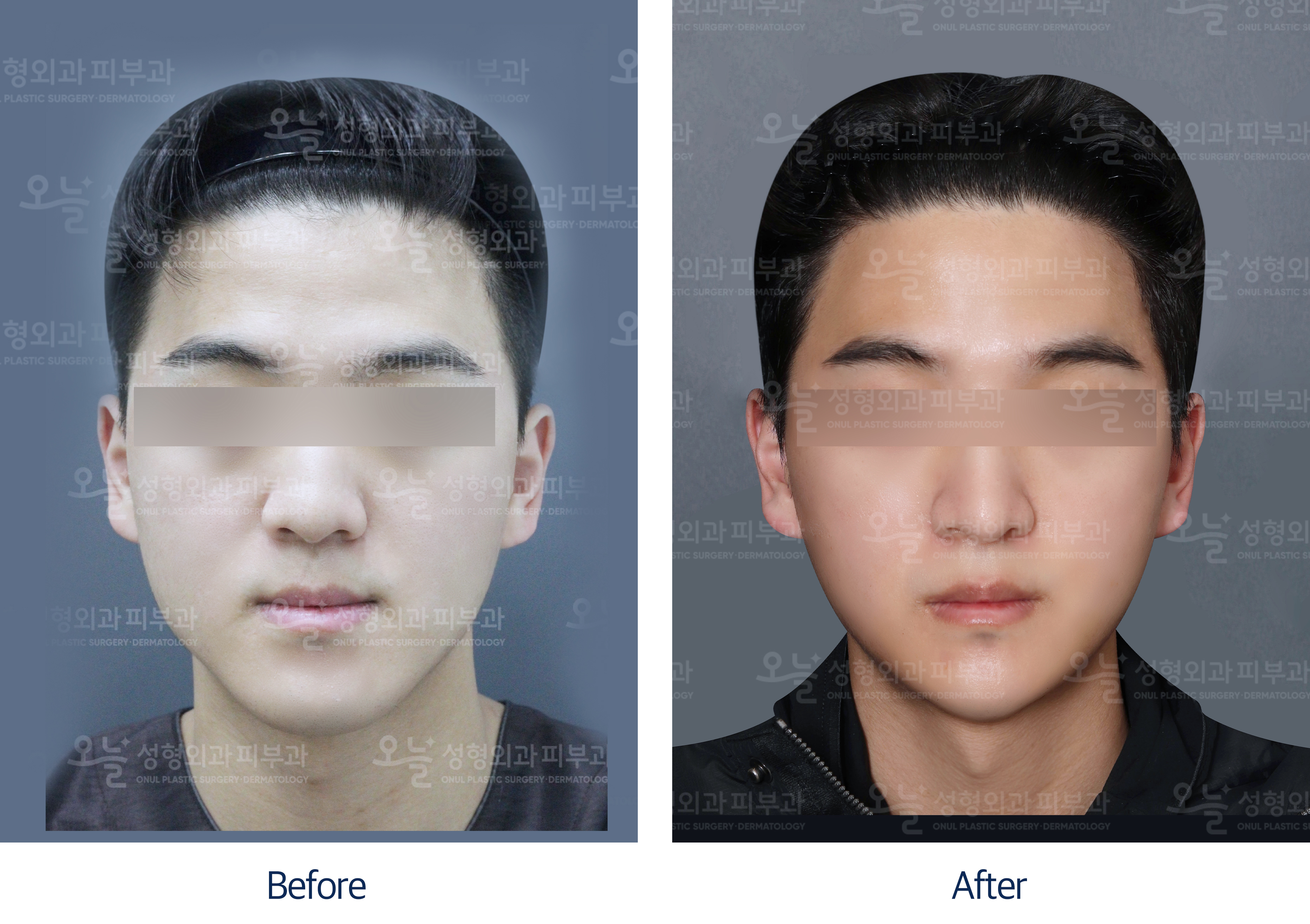 오늘성형외과 전후사진