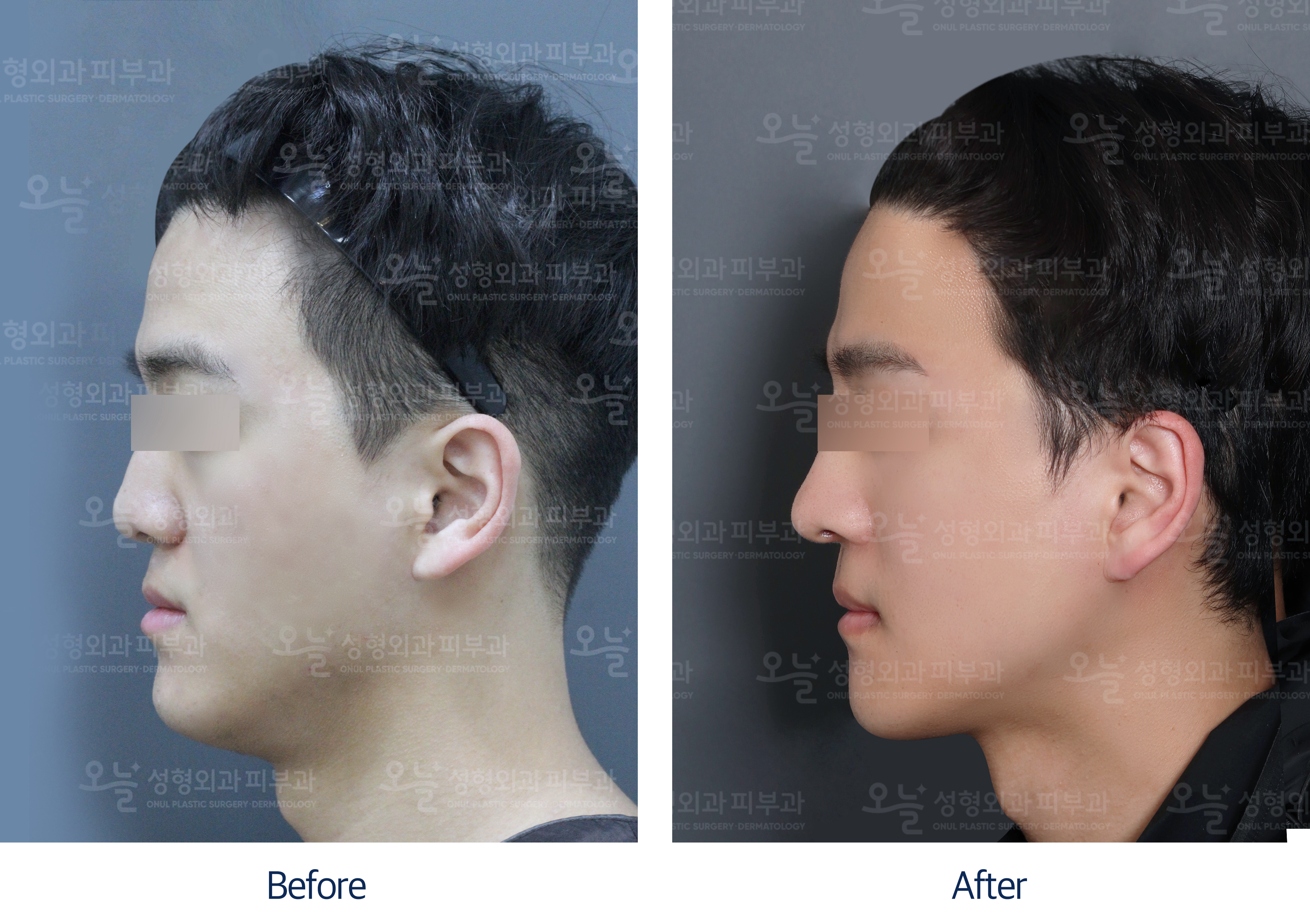 오늘성형외과 전후사진