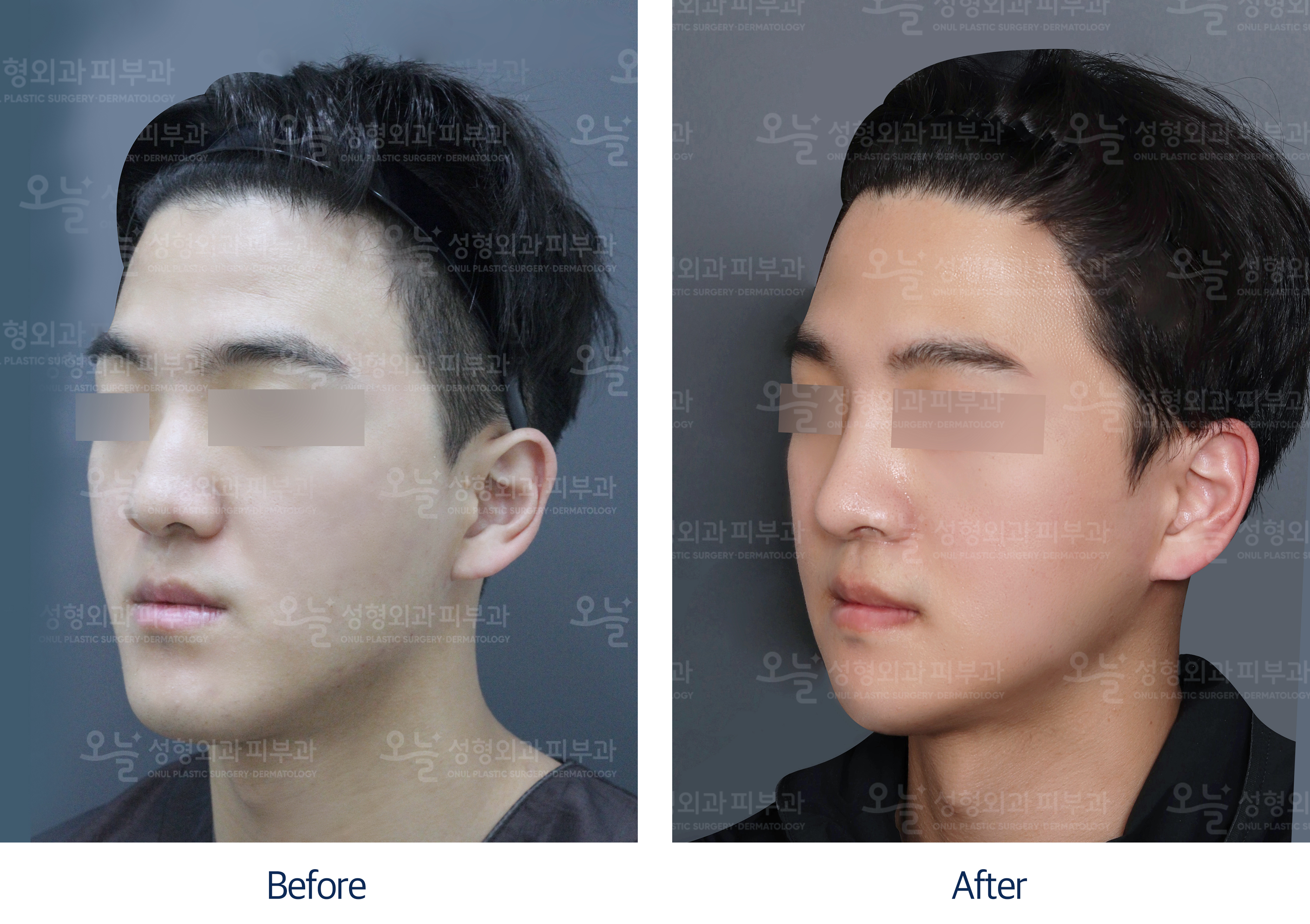 오늘성형외과 전후사진