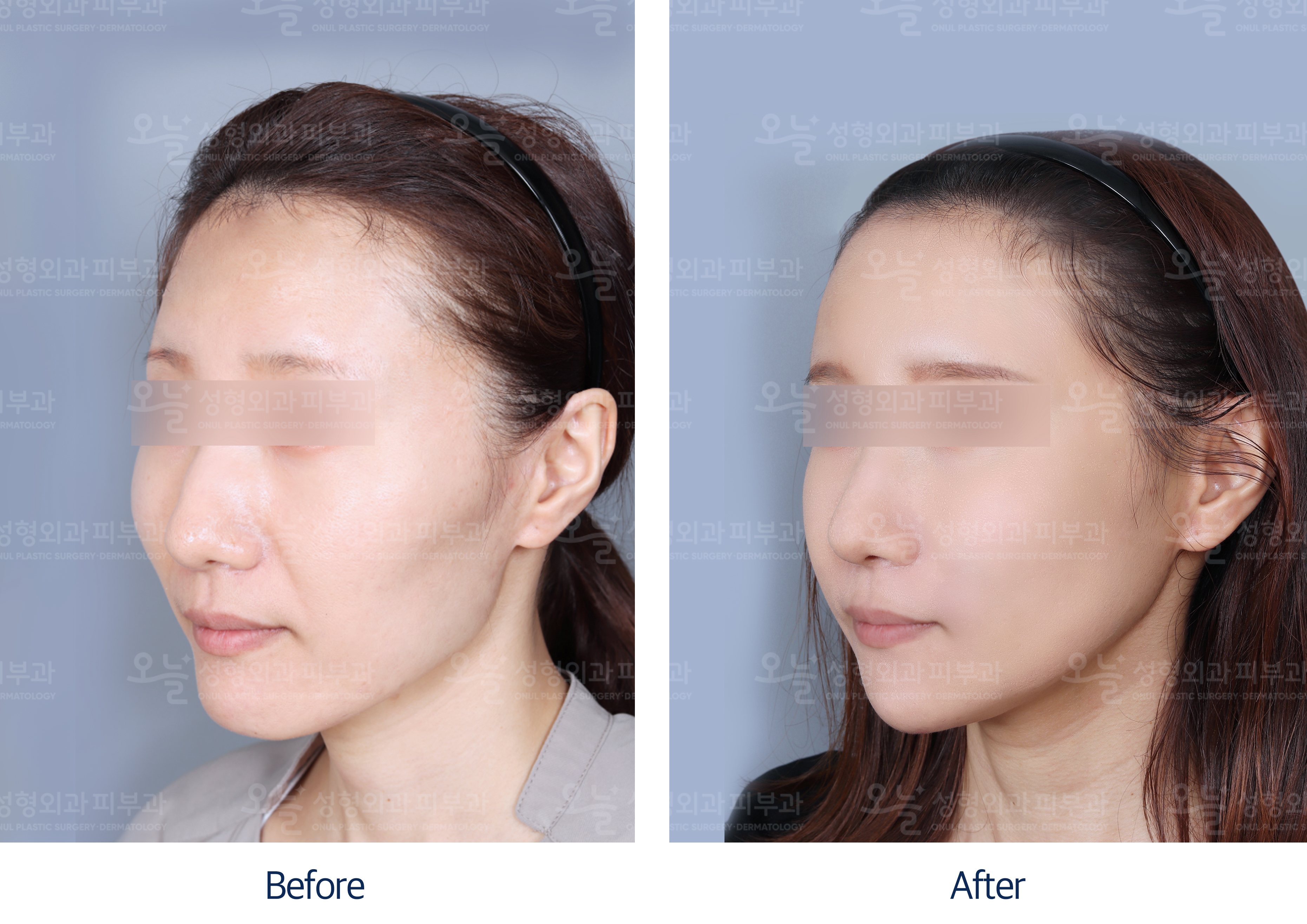 오늘성형외과 전후사진