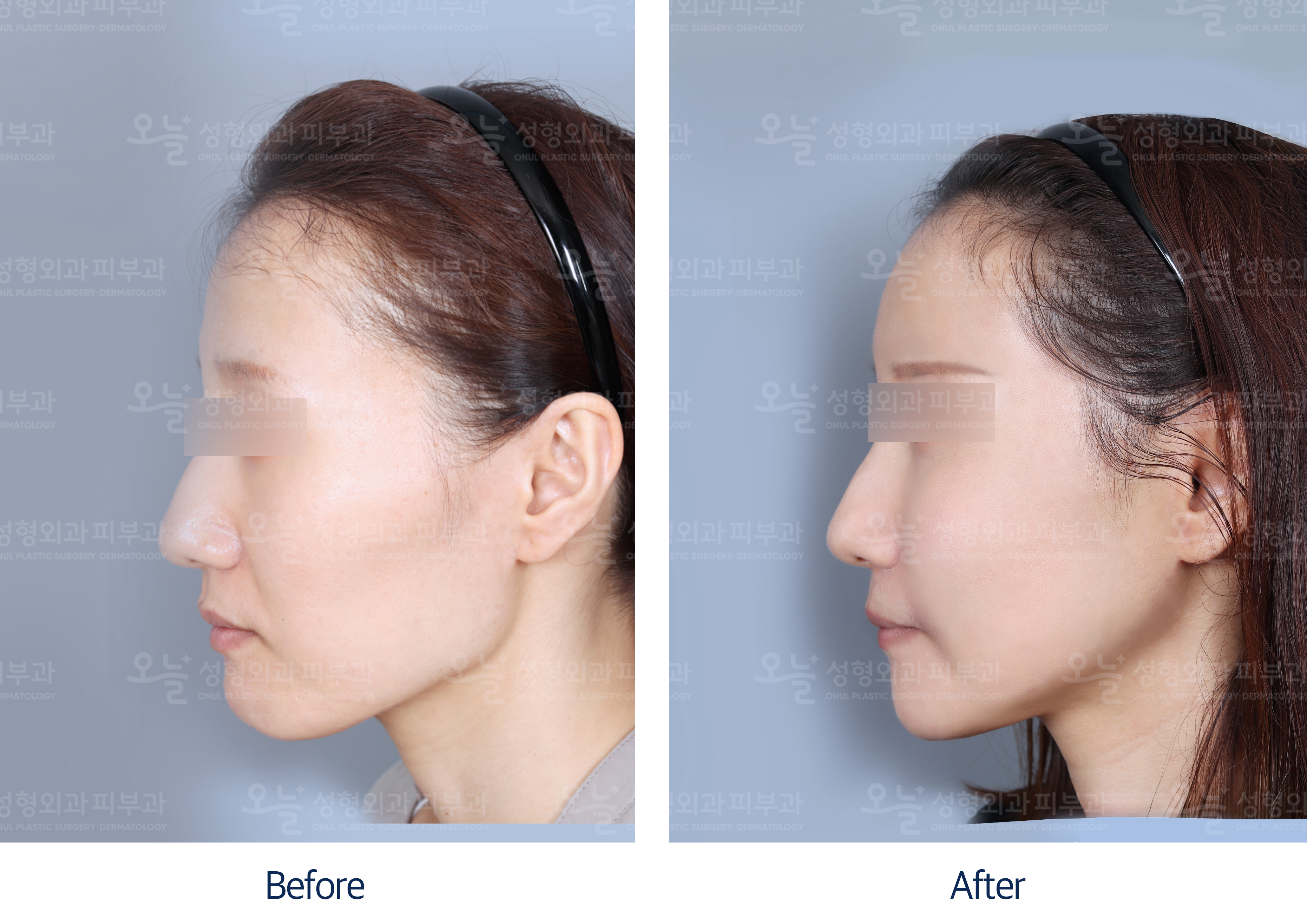 오늘성형외과 전후사진