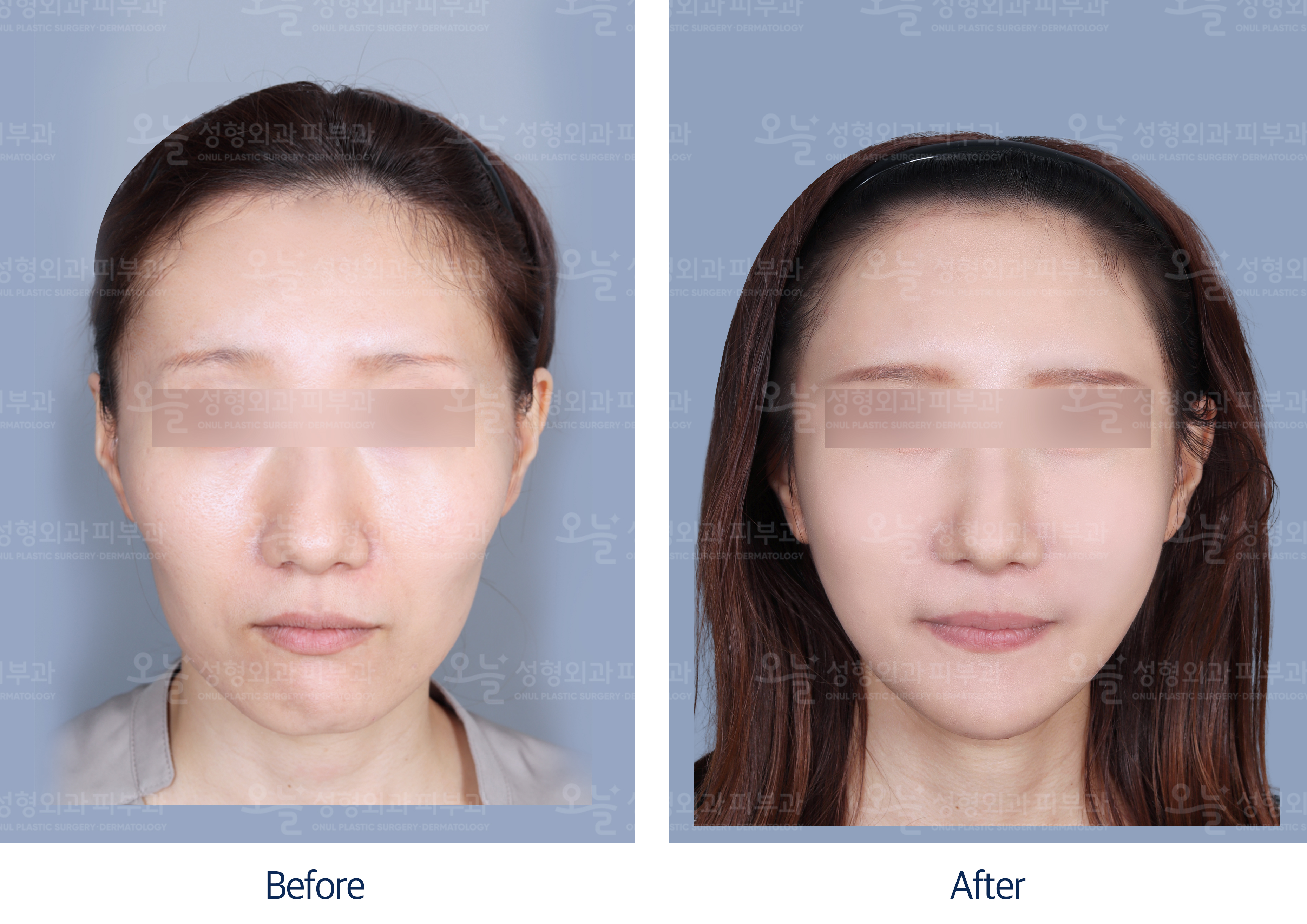 오늘성형외과 전후사진