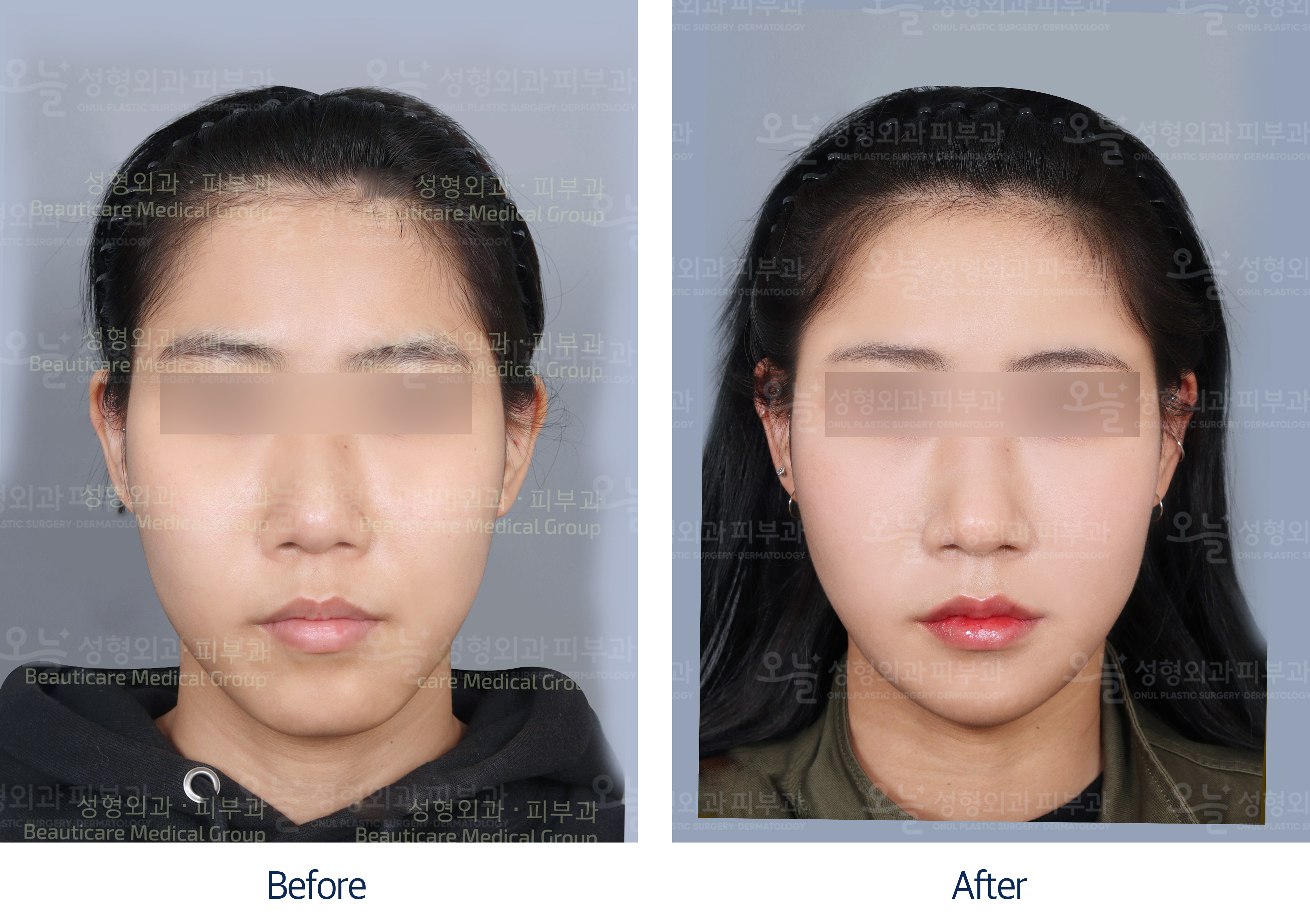오늘성형외과 전후사진
