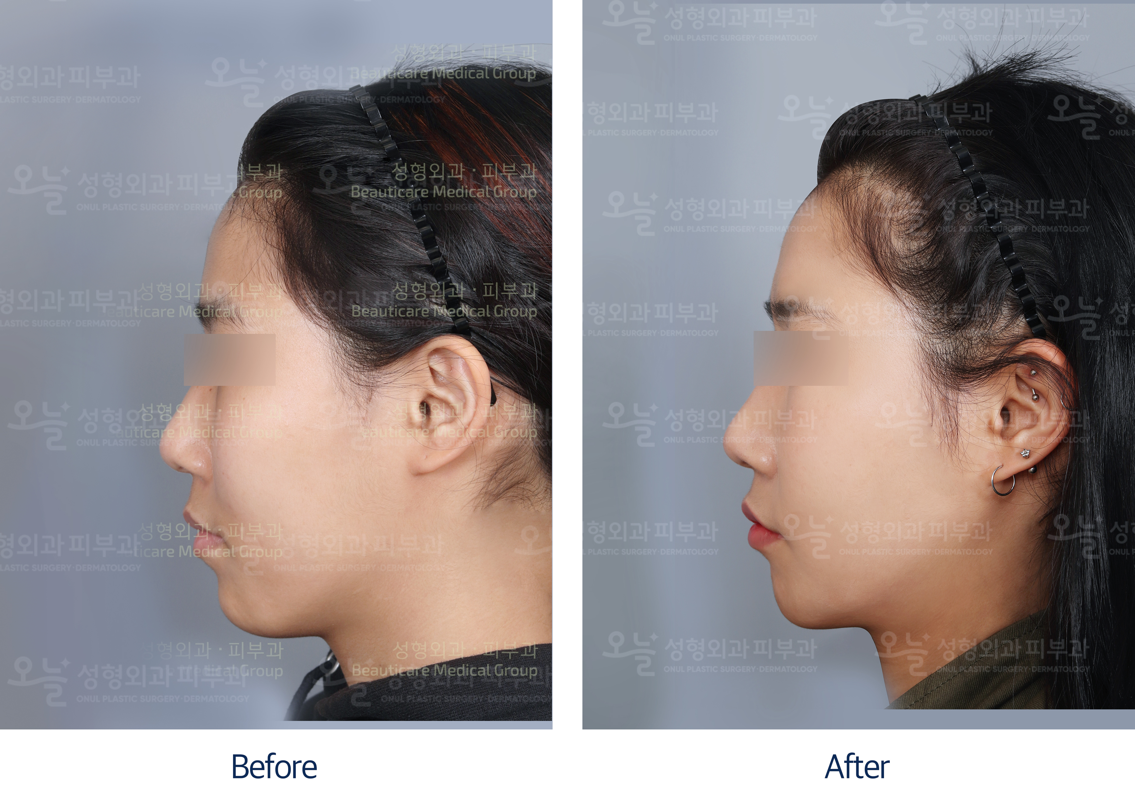 오늘성형외과 전후사진