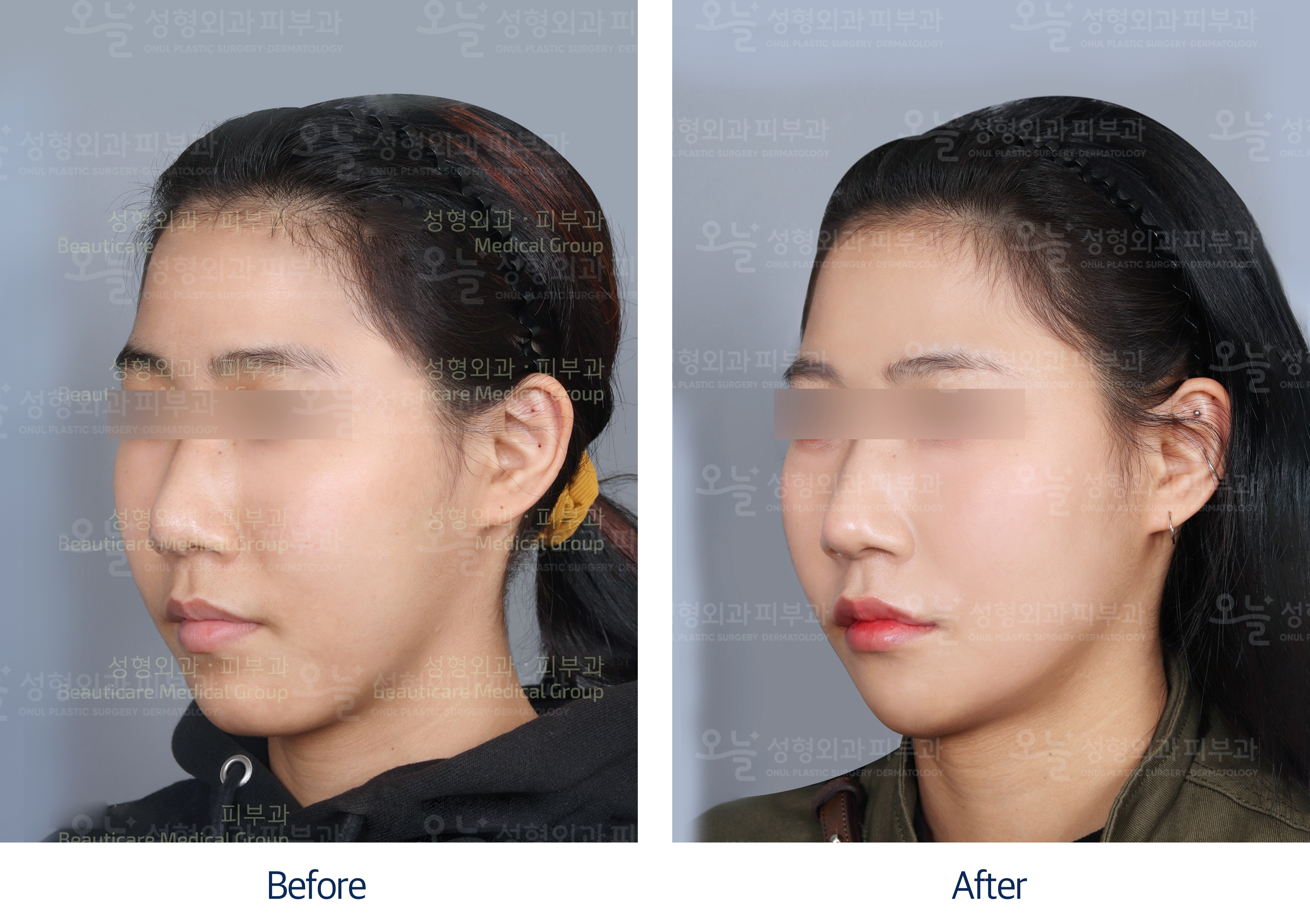 오늘성형외과 전후사진