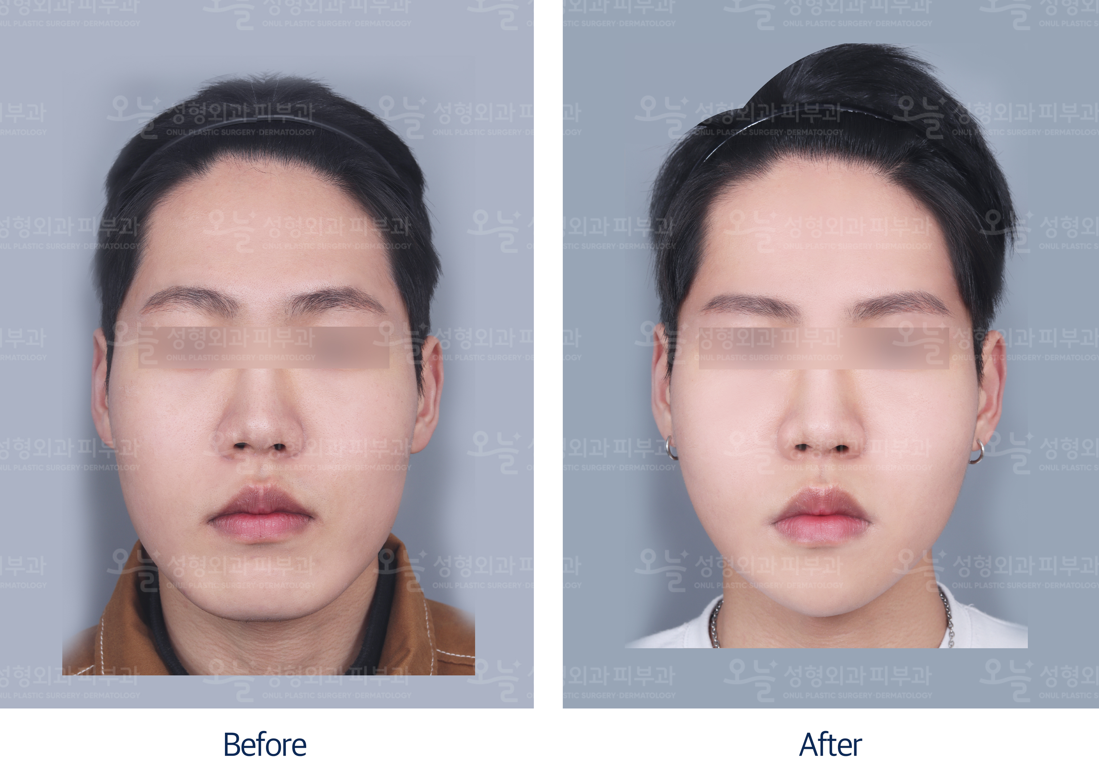 오늘성형외과 전후사진